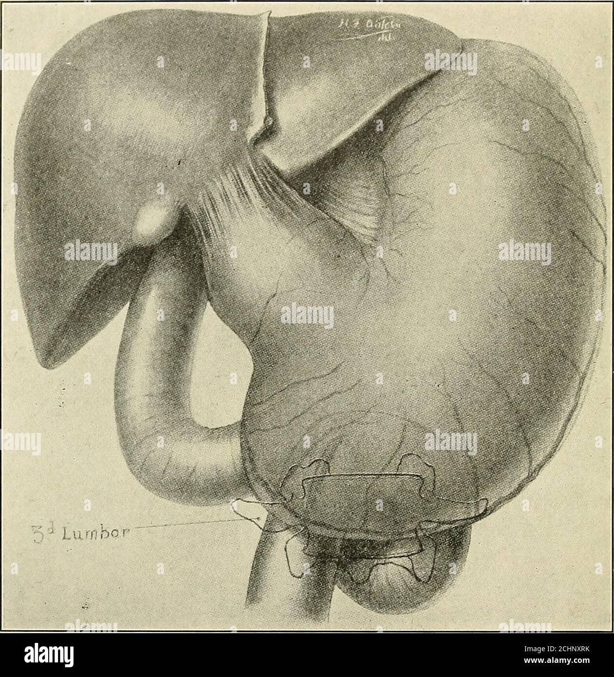 . Amerikanische Praxis der Chirurgie; ein komplettes System der Wissenschaft und Kunst der Chirurgie. ^ des Sakruwider, das es unter dem Einfluss von Iolenz auf die anteriorabdominale Wand wirkt. (Abb. 272.) VOL. VII. – 45 706 AMERIKANISCHE PRAXIS DER CHIRURGIE. Um die Wahrscheinlichkeit einer schweren Verletzung des Darms abzuschätzen, sollte trotz des Fehlens einer durchdringenden Bauchwunde eine akareful Geschichte des Charakters der Verletzung auslösten – Ob es aus dem plötzlichen Aufprall eines kleinen, sich schnell bewegenden Körpers wie ein Stück Holz, das von einer Kreissäge fliegt, resultiert, ein Fr. Stockfoto