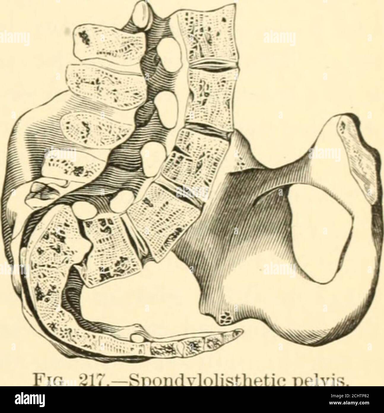 . Die Wissenschaft und Kunst der Hebamme . Die posterioren oberen iliac Dornen sind so weit voneinander getrennt, und die Spitze des Kreuzbeins wird nach vorne geworfen, wobei sie auf den antero-posterioren Durchmesser des Auslasses eingreifen. In einem von Breslau zitierten Fall besaß die sacro-iliac Synchondrose eine große Beweglichkeit. Die Zugkraft nach den ilio-femoralen Bändern, die der tubera ischii annähert, und die laterale Verschiebung der ilia, wegen der Re-Abtretung des Kreuzbeins, produzieren eine Verkürzung des transversalen Pelvicdurchmessers, der im Verhältnis zum Auslauf Isgenähert wird. Nach den jüngsten Einfgen Stockfoto