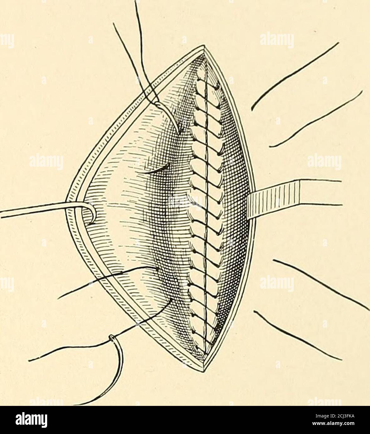 . Amerikanische Praxis der Chirurgie; ein komplettes System der Wissenschaft und der Kunst der Chirurgie . se. Die erste Reihe der Nähte wurde abgeschlossen und die arteriellen Öffnungen wurden ausgelöscht. Da die Wände der Sack sind in der Regel entspannt, ist es einfach, eine zweite Reihe von Nähten, die Sicherheit der ersten Reihe hinzufügen, und darüber hinaus reduzieren die Größe der Hohlraum, Die durch die in-Version der Haut und überschüssige Sack Wände in der alater Stadium in der Operation ausgelöscht werden soll. Diese zweite Reihe von Nähten wird wie in der ersten Reihe, entweder durch die kontinuierliche oder die unterbrochene Methode, mit einer gebogenen Nadel und angewendet Stockfoto