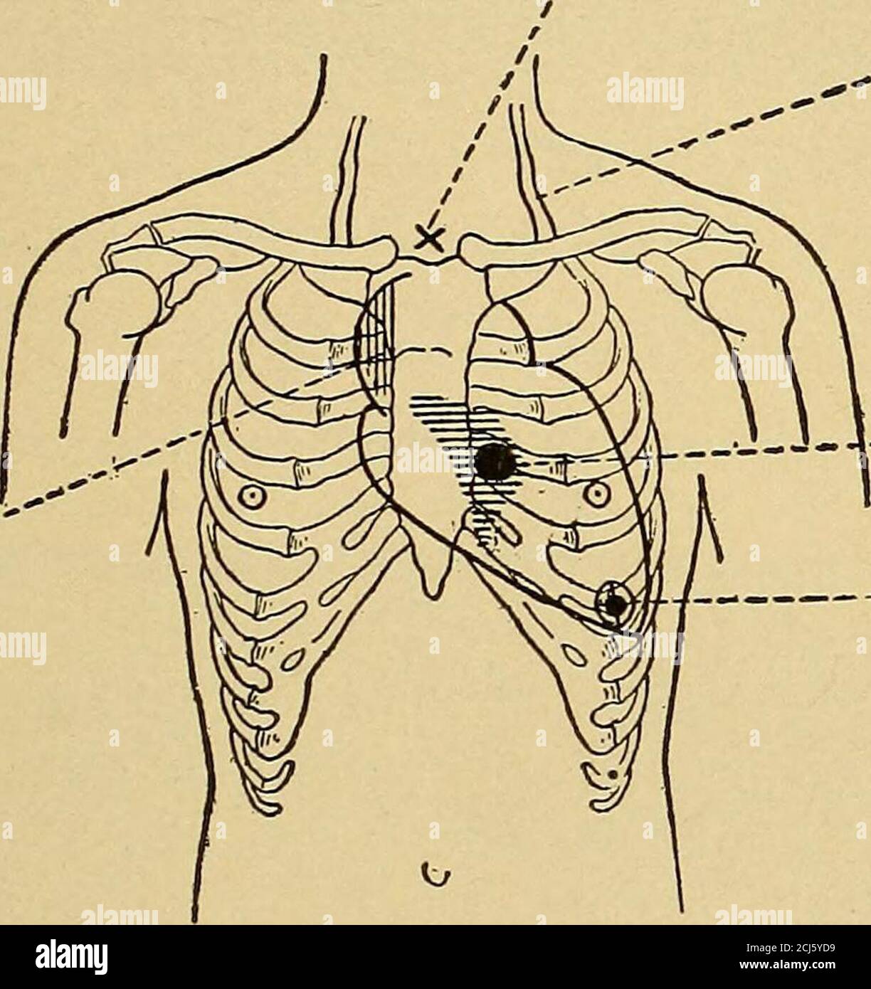 . Physikalische Diagnose . enin der suprasternalen Kerbe oder im zweiten rechten Zwischenraum. Nicht nur die Karotis, sondern die Subclaviane, die Brachiale und Radiale, die femorale und anteriore Tibia, und sogar die digitalen und dorsalispedis Arterien können sichtbar pulsieren, und die charakteristische Ruckqualität des Pulses kann sowohl gesehen als auch gefühlt werden. Diese sichtbare pul-sation in den peripheren Arterien? Während sehr charakteristisch für AORTENKLAPPENLÄSIONEN. 231 Regurgitation, wird gelegentlich in Fällen von einfacher Hypertrophie des Herzens von harter Muskelarbeit gesehen {z.B. bei Athleten). Wenn die ar-teries umfangreich sind Stockfoto