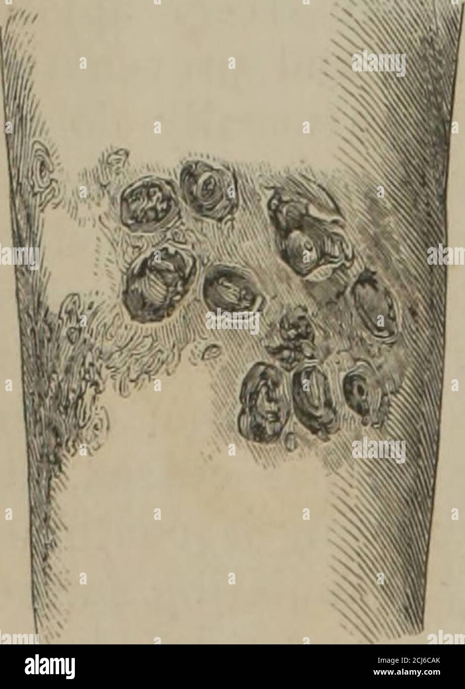 . Die Prinzipien der Chirurgie . Patienten sind Erwachsene. Es gibt eine PluralitätAbb. - 38- von Öffnungen; und subkutane Kommunikation kann oder kann nicht existieren. Die Geschwüre sind gewöhnlich von dem schwachen Charakter; können aber, nebenbei bemerkt, reizbar oder entzündet sein. Die DIS-Ladung ist dünn und serous; die umgebende skinis dusky und leicht geschwollen; und häufig, in der Nachbarschaft des Ohrs, gibt es cicatrices, per-haps ausgedehntes, wo ähnliche Geschwüre formerlybeen hatten. Schmerz ist beträchtlich; das Glied ist wastedand schwach; und das Antlitz trägt thewell-bekannten Ausdruck dieses konstitutionalevil, das das ro ist Stockfoto