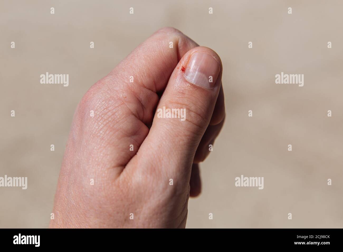 Hauttrauma Stockfotos Und Bilder Kaufen Alamy