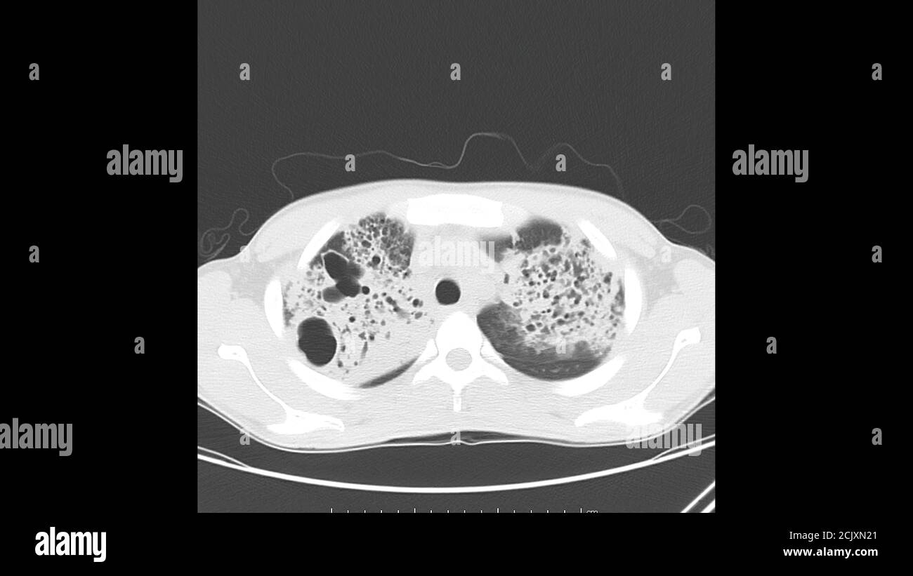 Axiale Computertomographie des Brustkorbs (Lungenfenster) Bei einem bekannten Patienten mit aktiver Tuberkulose (TB) mit Lungenentzündung Und Kavitation in beiden Lungen Stockfoto