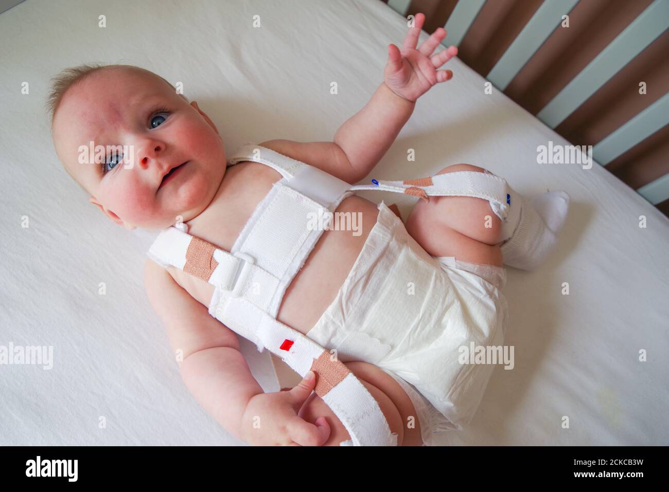 4 Monate altes Baby mit Hüftdysplasie behandelt Ein Pavlik Geschirr Stockfoto