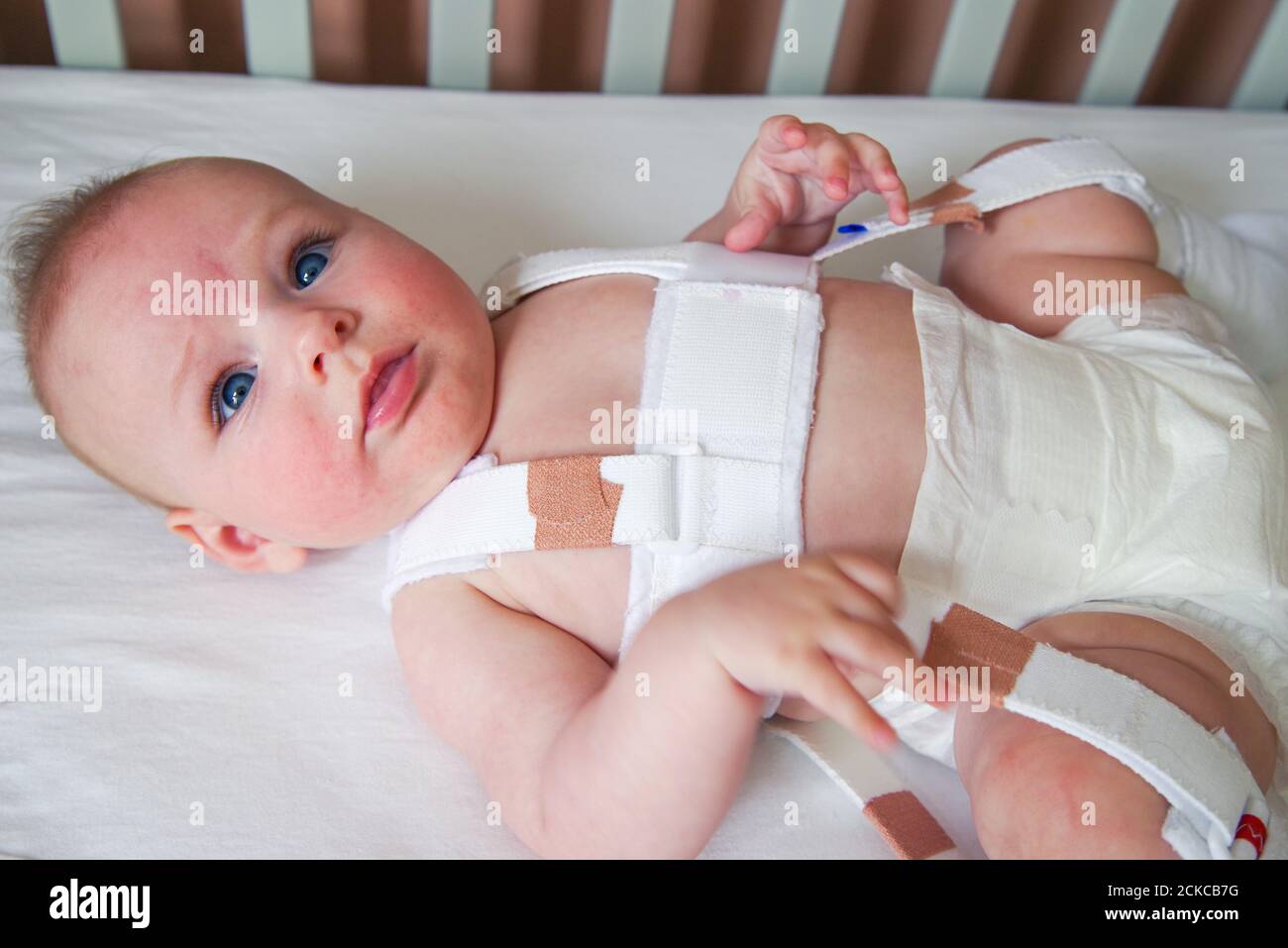 4 Monate altes Baby mit Hüftdysplasie behandelt Ein Pavlik Geschirr Stockfoto