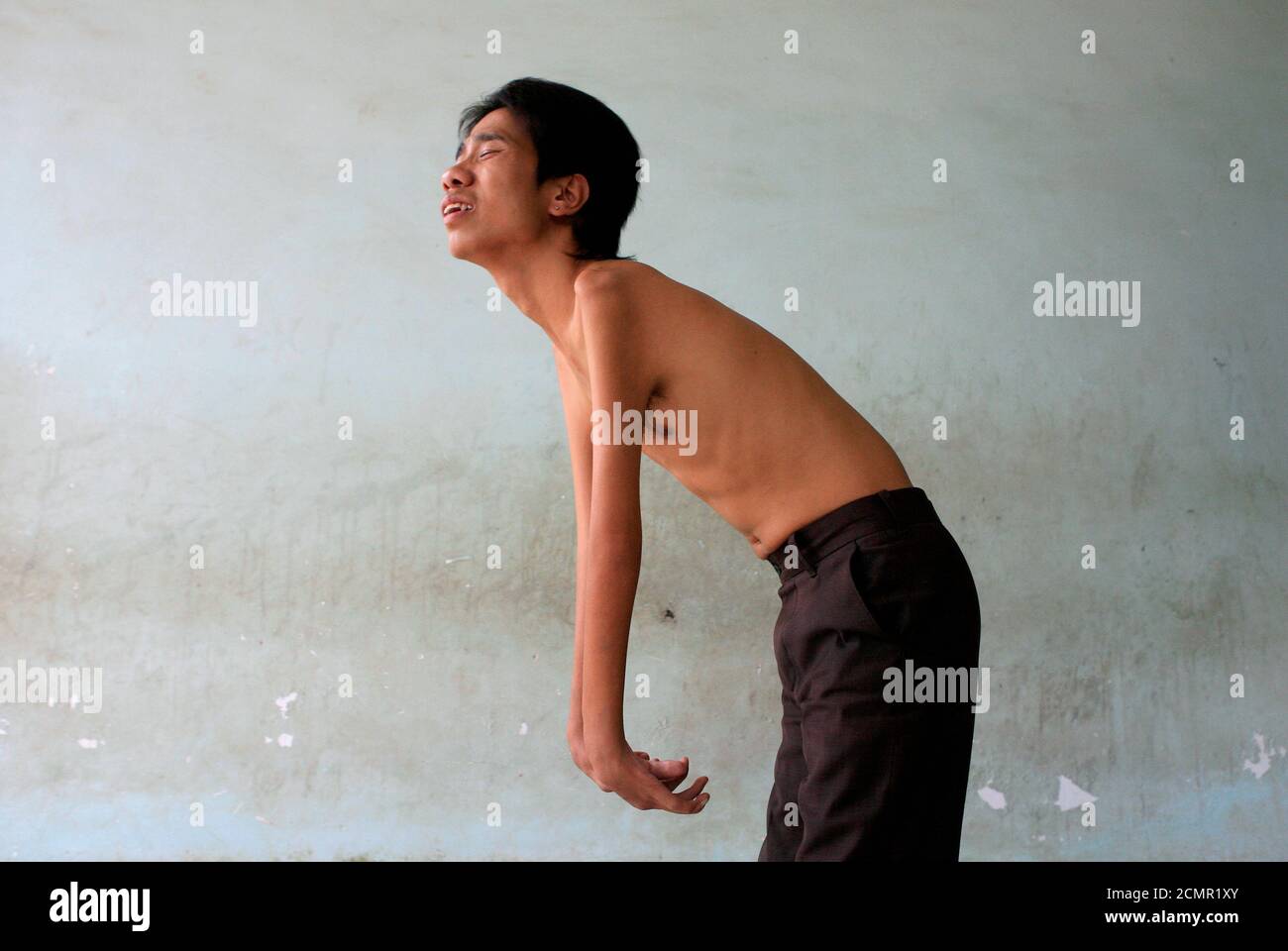 Agent orange opfer vietnam Stockfotos und -bilder Kaufen - Alamy