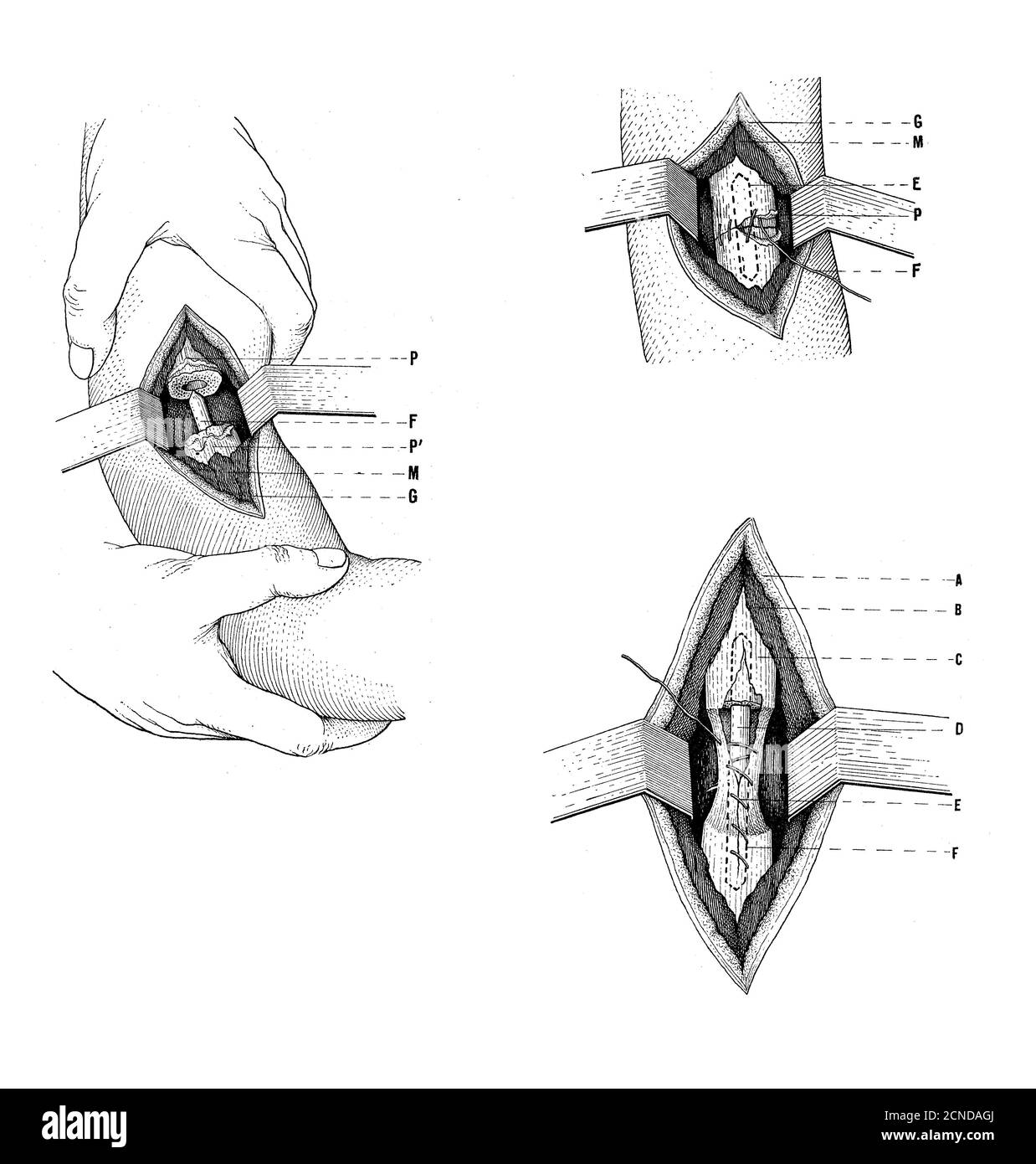 Gesundheitswesen, Medizin und Chirurgie: Zeichnung, die erklärt, wie man eine zentrale Nagelung des Oberarms durchführt, Vintage Illustration Stockfoto