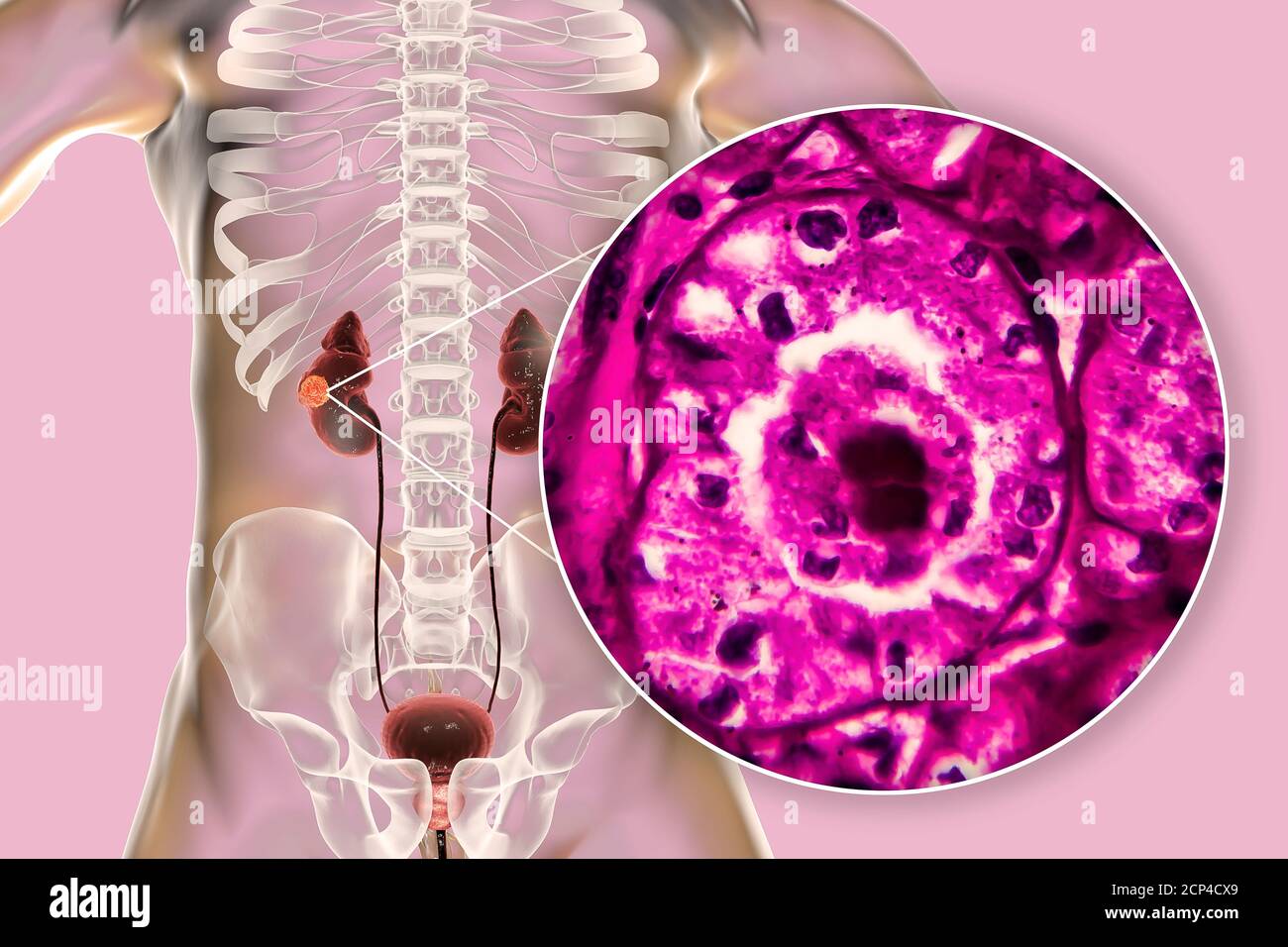 Nierenkrebs, Computerdarstellung und leichte Mikrograph. Stockfoto