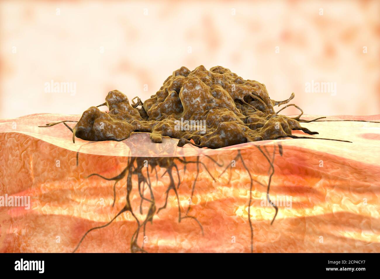 Krebs-Invasion in umliegende Gewebe, konzeptionelle Computer-Illustration. Stockfoto