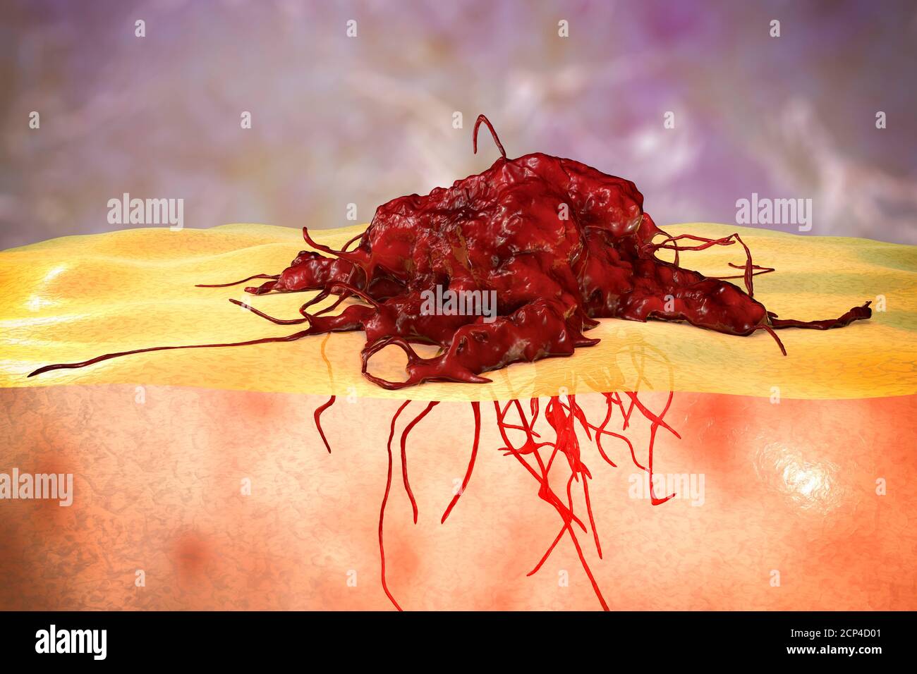 Krebs-Invasion in umliegende Gewebe, konzeptionelle Computer-Illustration. Stockfoto