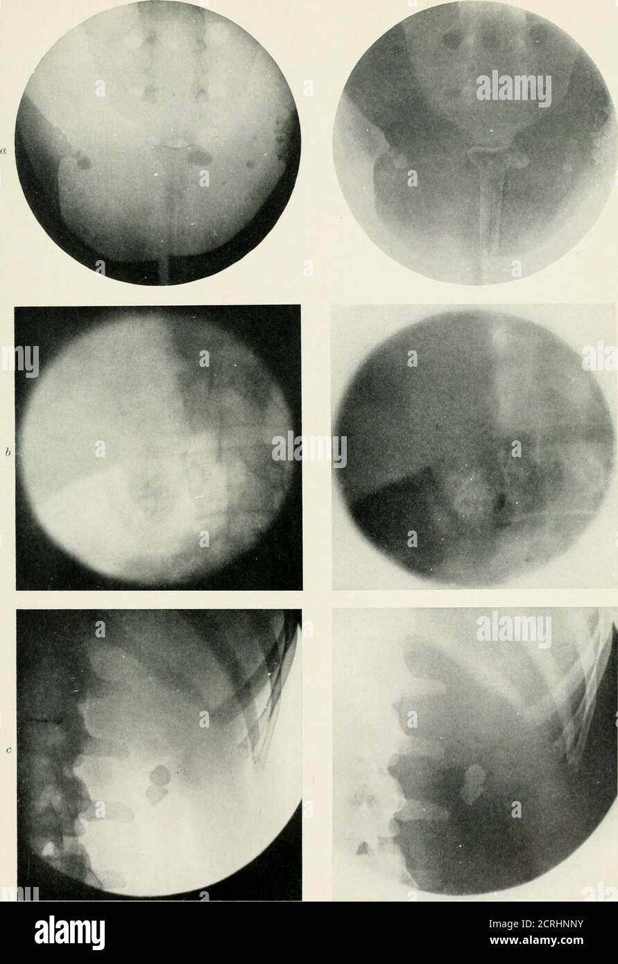 . Radiographie, Röntgentherapeutika und Radiumtherapie. Nerale Tuberkulose, wenn Miliärtuberklesegefunden werden, die die Organe besät. Die Radiographie ist in dieser Vielfalt selten von großem Dienst. B) aufsteigende Tuberkulose kann aus einer ähnlichen Blasenbefall entstehen. Die Schleimhaut des Harnleiters wird verdickt und das Becken und die Calices werden ebenfalls betroffen. Bei klinischer Untersuchung ist die Vergrößerung der Niere die nächste Manifestation. Radiographie kann hilfreich sein, die vergrößerten Nieren zu demonstrieren; und wenn Kasusmaterie presentor Abszesse bilden, kann das Negative diese Affektionen zeigen, (c) Stockfoto