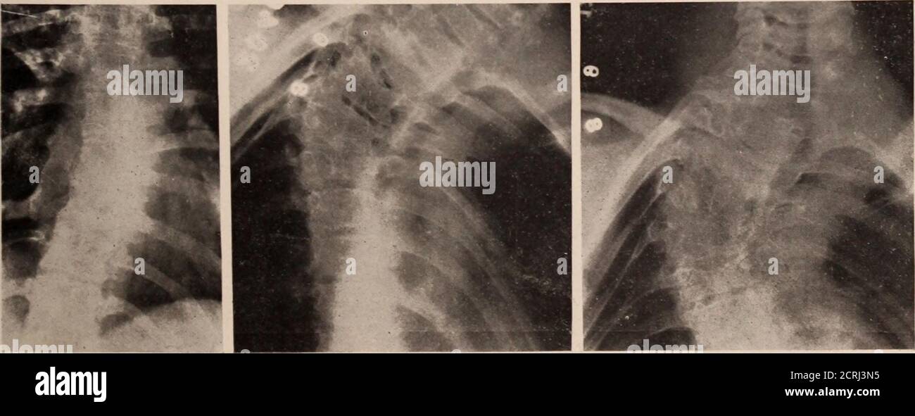 . Journal of Radiology . oder developmentale Anomalie in einer Rippe Surelyist mit einer Anomalie in der Wirbel assoziiert, aber das Gegenteil ist nicht wahr. Er berichtete auch, dass die Kongenitalhöhung eines oder beider Scapulae manchmal mit Anomalien der Wirbellosen oder Rippen gefunden wird. Hodgson hat viele Platten von Anomalien der Spineund Rippen. Roth, im Jahr 1920, berichtet Acase, in dem eine zusätzliche Hälfte vertebraon der linken Seite, zwischen den Eleventhand zwölften dorsalen Segmenten, trug arib. Nur die Hälfte des neunten Dorsals war vorhanden und es wurde mit dem Elften verschmolzen. Skoliose hatte sich ergeben. Bericht zu Fall 1 (A Stockfoto