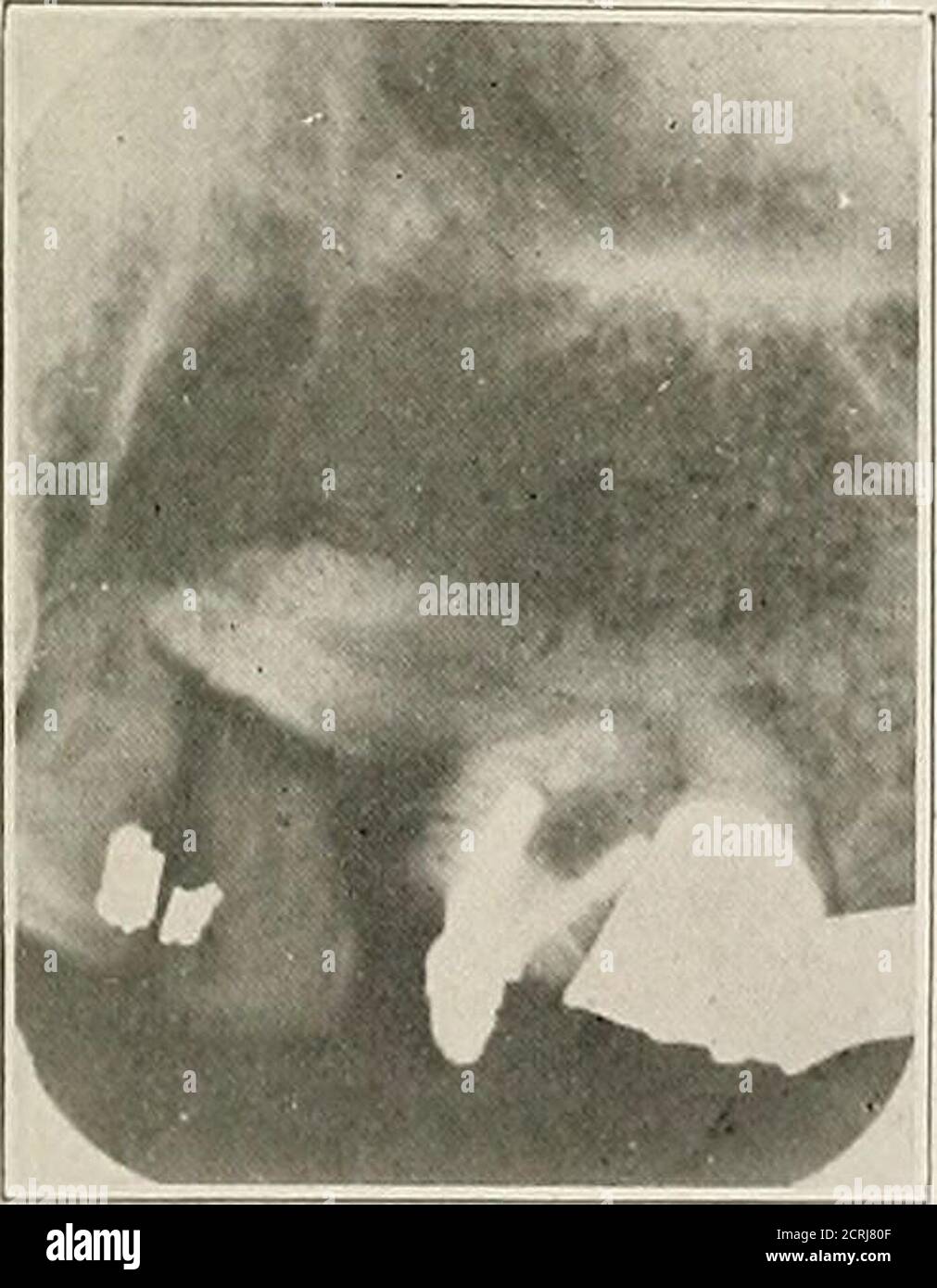 . Interpretation von zahnärztlichen und kieferförmigen Roentgenogrammen . Abb. 222. Abb. 223. Stockfoto