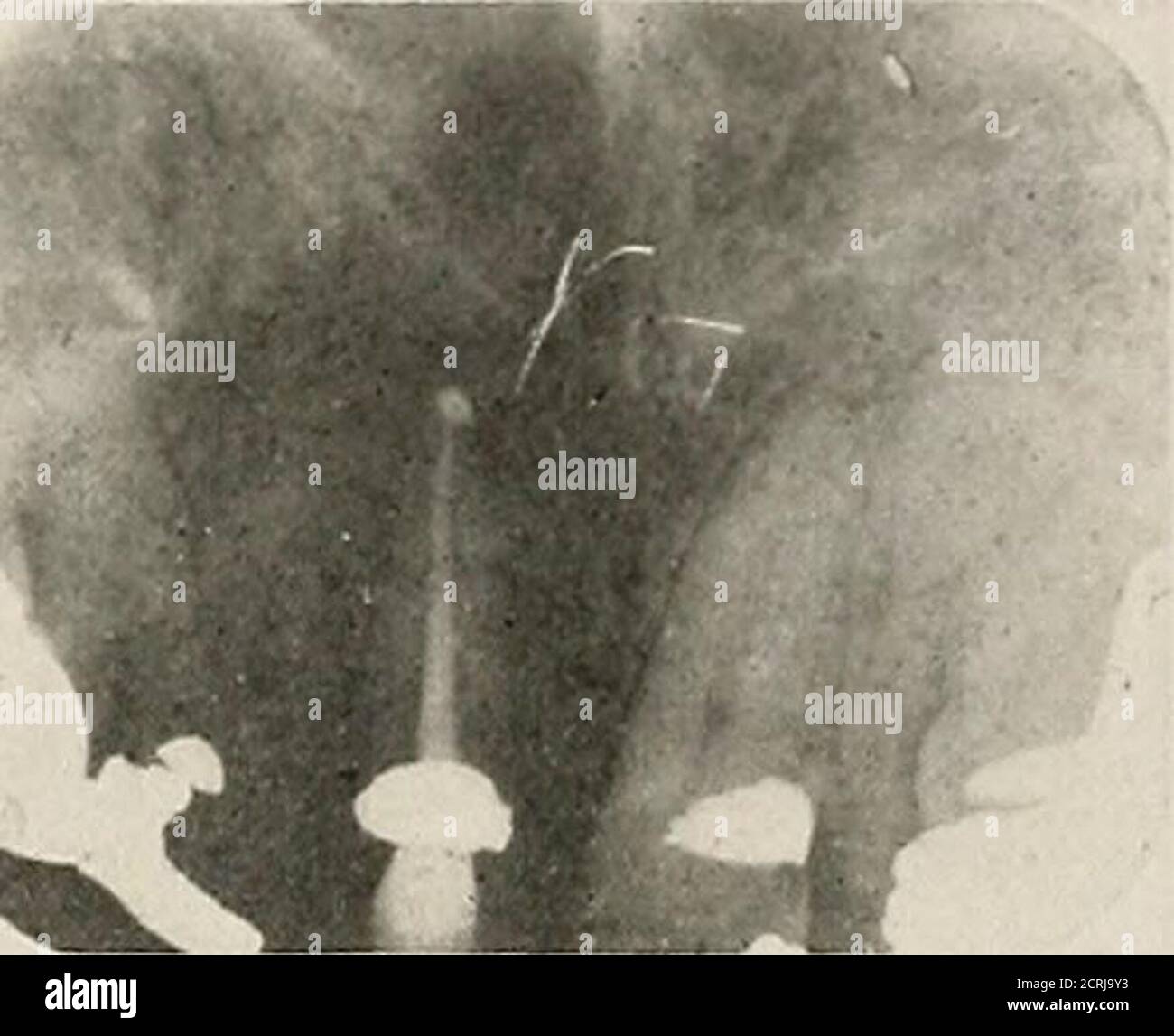 . Interpretation von zahnärztlichen und kieferförmigen Roentgenogrammen . Abb. 214. Abb. 215. Stockfoto