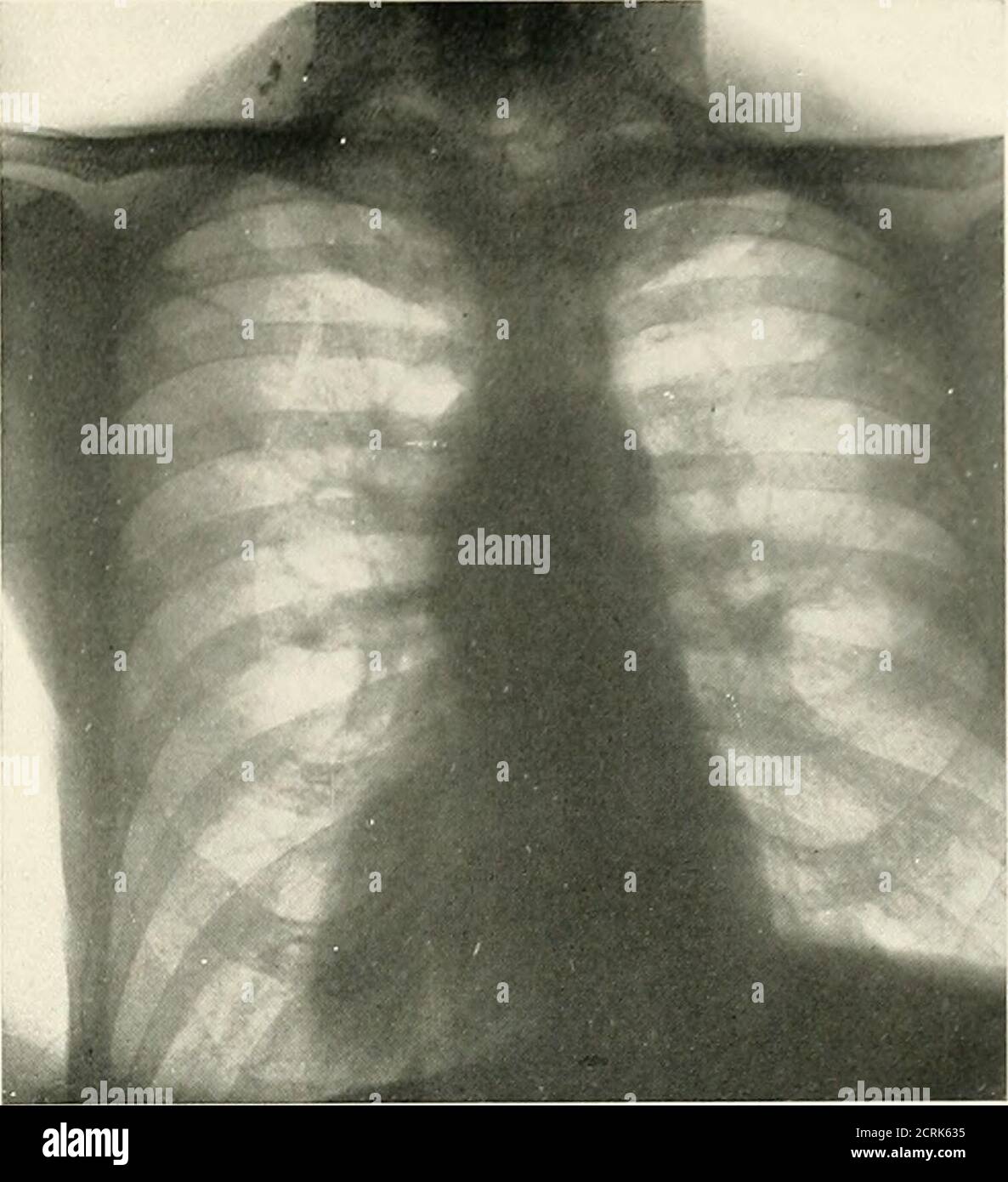 . Radio-Diagnose der pleuro-pulmonalen Zuneigung . Nr. 1389. J. K ...