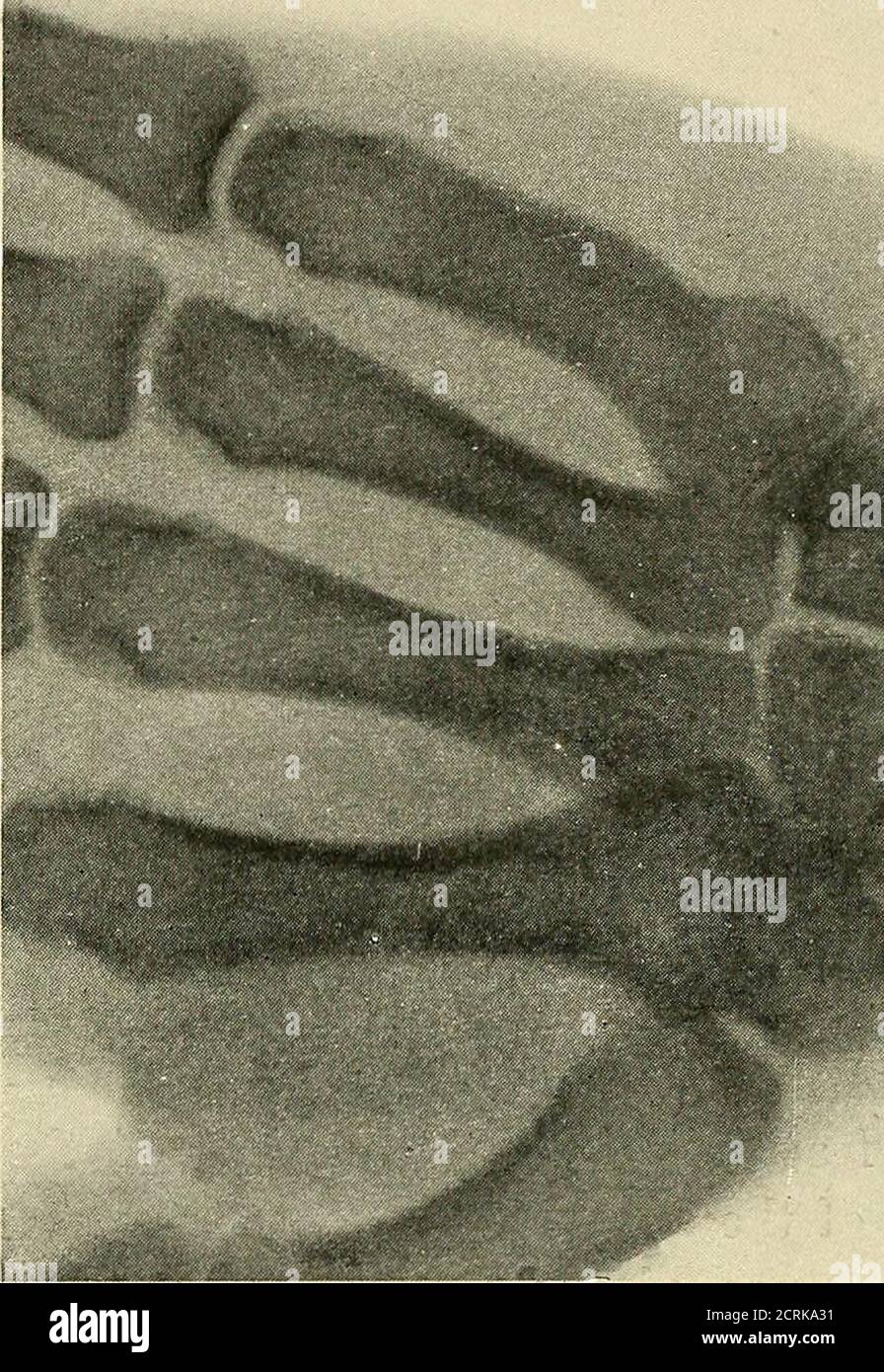 . Röntgenstrahlendiagnose und -Therapie . die Kraft, die dem sehr starken radialen Ende zugefügt wird, wird auf den weniger widerstandsfähig wirkenden Scaphoid-Knochen transferiert. Was die Frakturen anderer Karpaltknochen (os lunatum), die Leserin bezieht sich auf Annals of Surgery, August, 1901. Die Frakturen des Karpus sind zweifellos häufiger als allgemein angenommen. Aber sie wurden nicht für-merly erkannt. Metacarpus. – die Rontgenstrahlen haben auch die alte dic-tum von der Seltenheit der Fraktur der Metacarpalknochen erschüttert. Es kann kein Zweifel mehr daran bestehen, dass eine große Anzahl von angeblichen Verrenkungen und Prellungen des Metacs Stockfoto