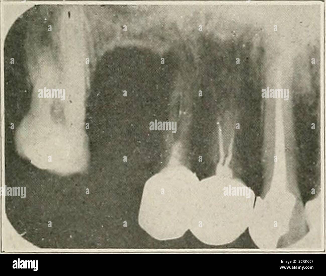 . Interpretation von zahnärztlichen und kieferförmigen Roentgenogrammen . Abb. 22.-C.. Stockfoto