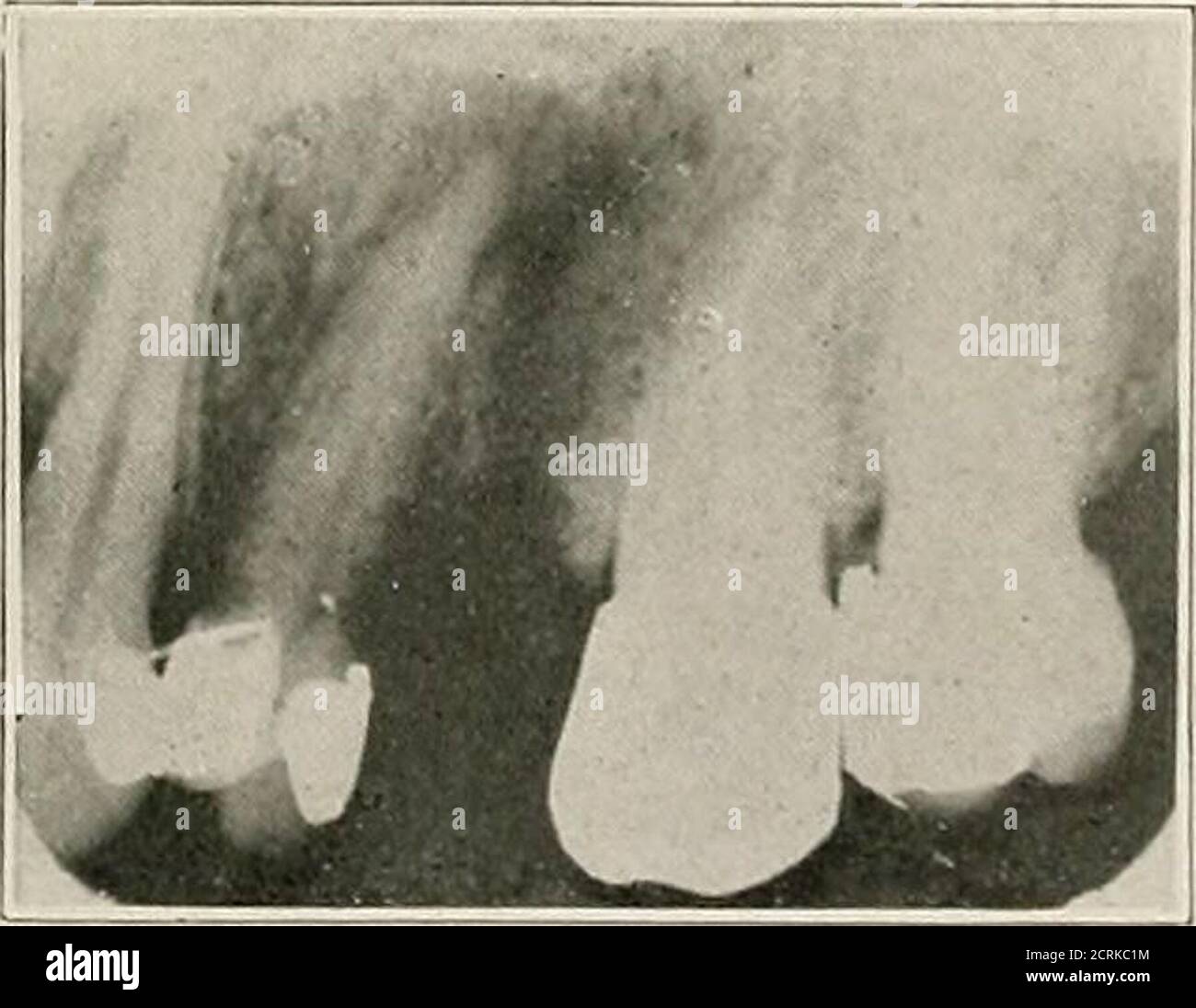 . Interpretation von zahnärztlichen und kieferförmigen Roentgenogrammen . Abb. 22-D. Abb. 22-E.. Abb. 22-R Stockfoto