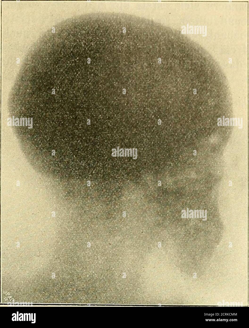 . Klinische und anatomische Untersuchungen über den Cretinismus . Radiologiscie Untersuchenungen.Fio;. 46. 183. Abb. f47. Stockfoto