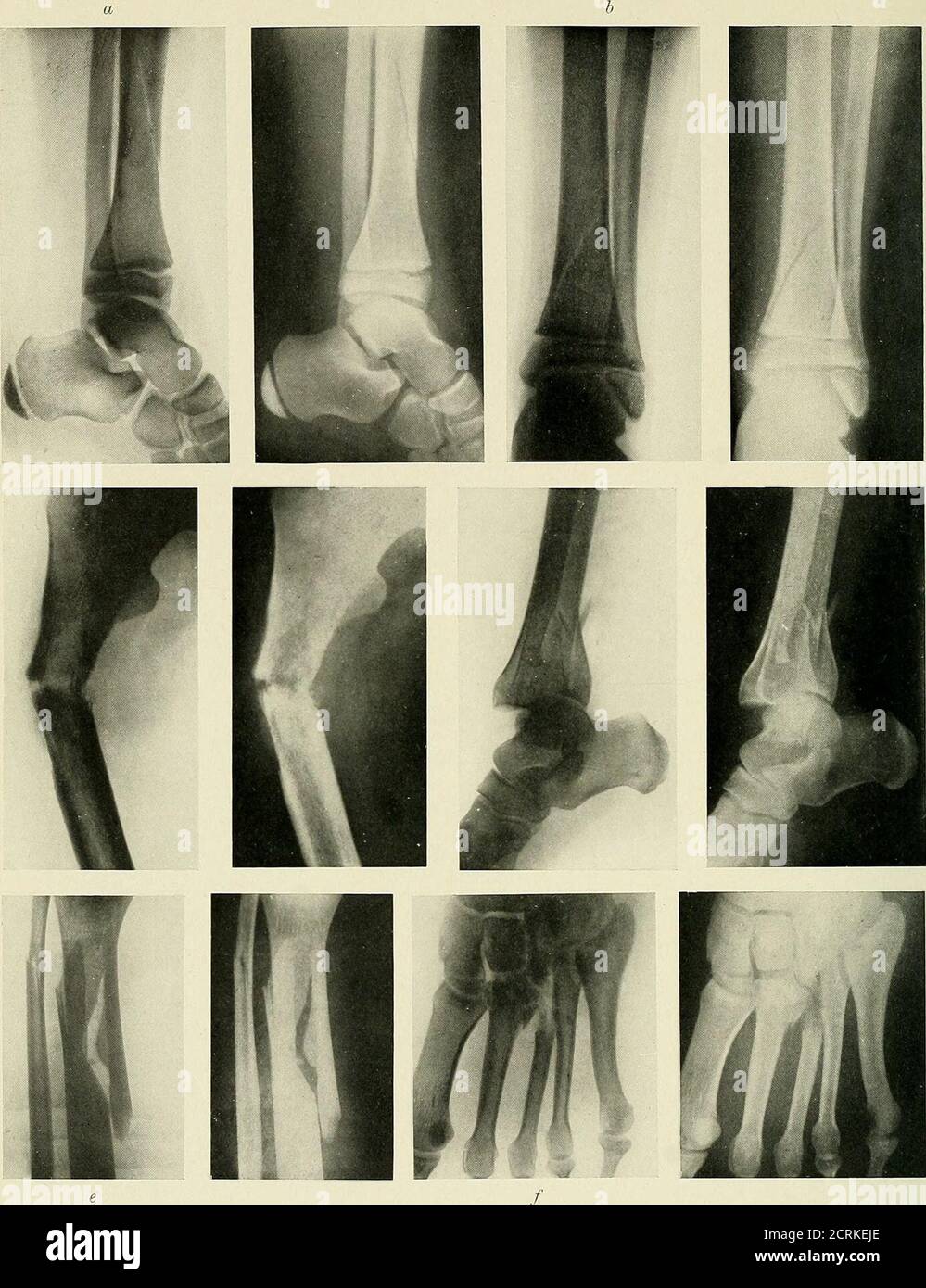 . Radiographie, Röntgentherapeutika und Radiumtherapie . PLATTE XX. – Brüche am Knöchelgelenk. a. Schräge Fraktur durch unteres Fibelende, (a) lateral, {b) antero-posteriore Ansichten. b, Fraktur der inneren und äußeren Malleolen, Verschiebung des Fußes nach außen am Knöchelgelenk. c, Fraktur des Astragalus. d, Fraktur Dislokation am Knöchelgelenk. e. Bruch unteres Ende der Fibel.. PLA.TE XXI. - Fraktokes von Bein, Knöchel und Fuß. «, Oblique Fracture of Shaft of Tibia, lateral view, zeigt Epiphjsen des unteren Endes der Tibia und auch OFOS calcis. b, Antero-posterior view of Tibia and fibula, showing an ob Stockfoto