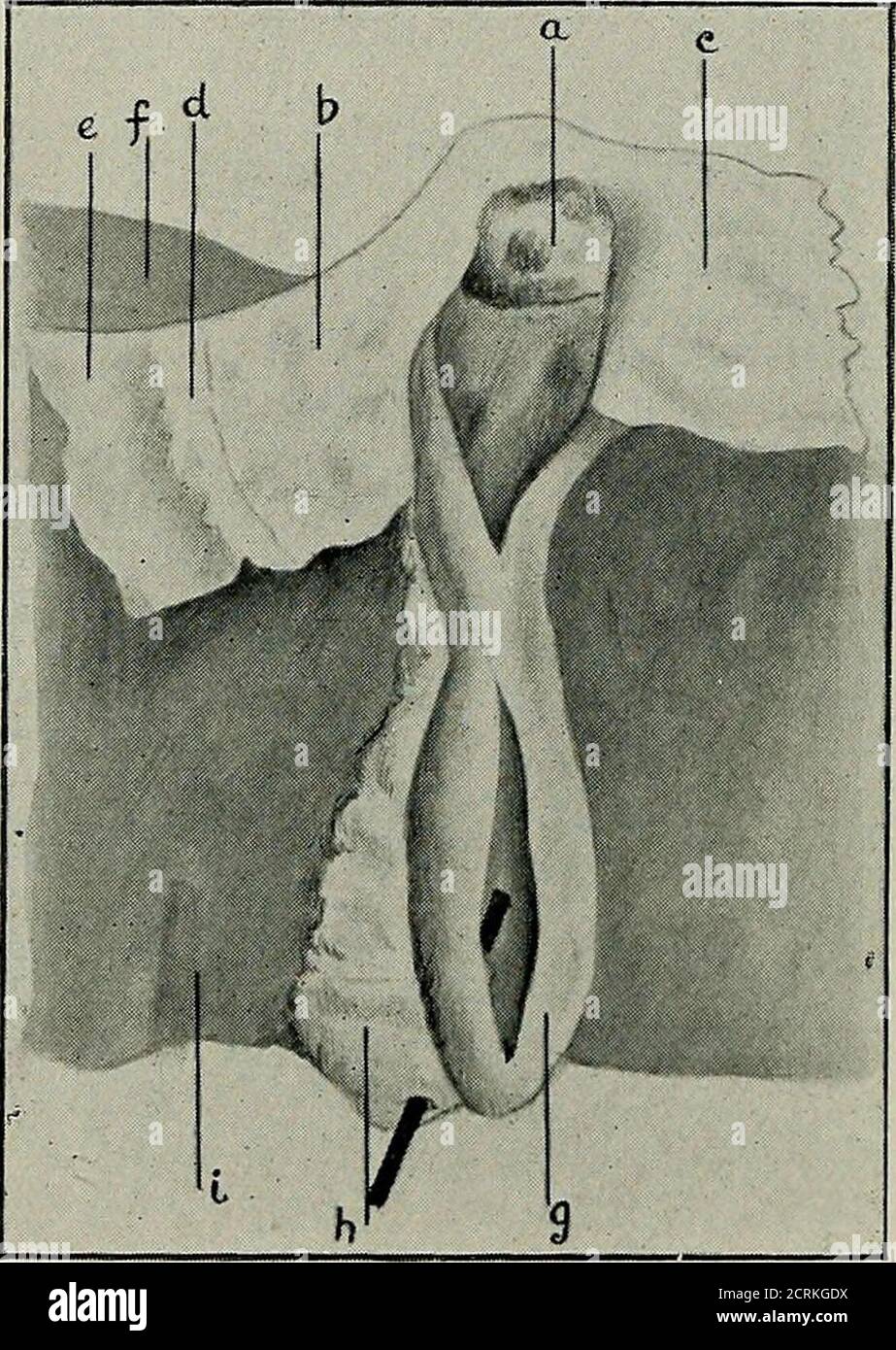 . Erkrankungen der Gallenblase und Gallengänge, einschließlich Gallensteine. Er Mukosegang. An der Kreuzung der zystischen, hepatischen und gemeinsamen Gallengänge gelegen, war ein Wachstum von etwa der Größe eines Filbert, die gefunden wurde, wenn die Kanäle geöffnet wurden, um sie vollständig zu verschließen (siehe Abb. L 41, S. Es gab keine Anhaftungen in der Nachbarschaft, noch gab es irgendwelche sekundären Wucherungen zu finden. Der Magen zeigte keine Anzeichen von Ulzeration, aber es gab leichte Anzeichen von Leberzirrhose. Es gab keine Peritonitis. Krebs der Ampulle von Vater wurde vermutlich zuerst 10 beschrieben – 2 148 KRANKHEITEN DES GALL-BLADD Stockfoto