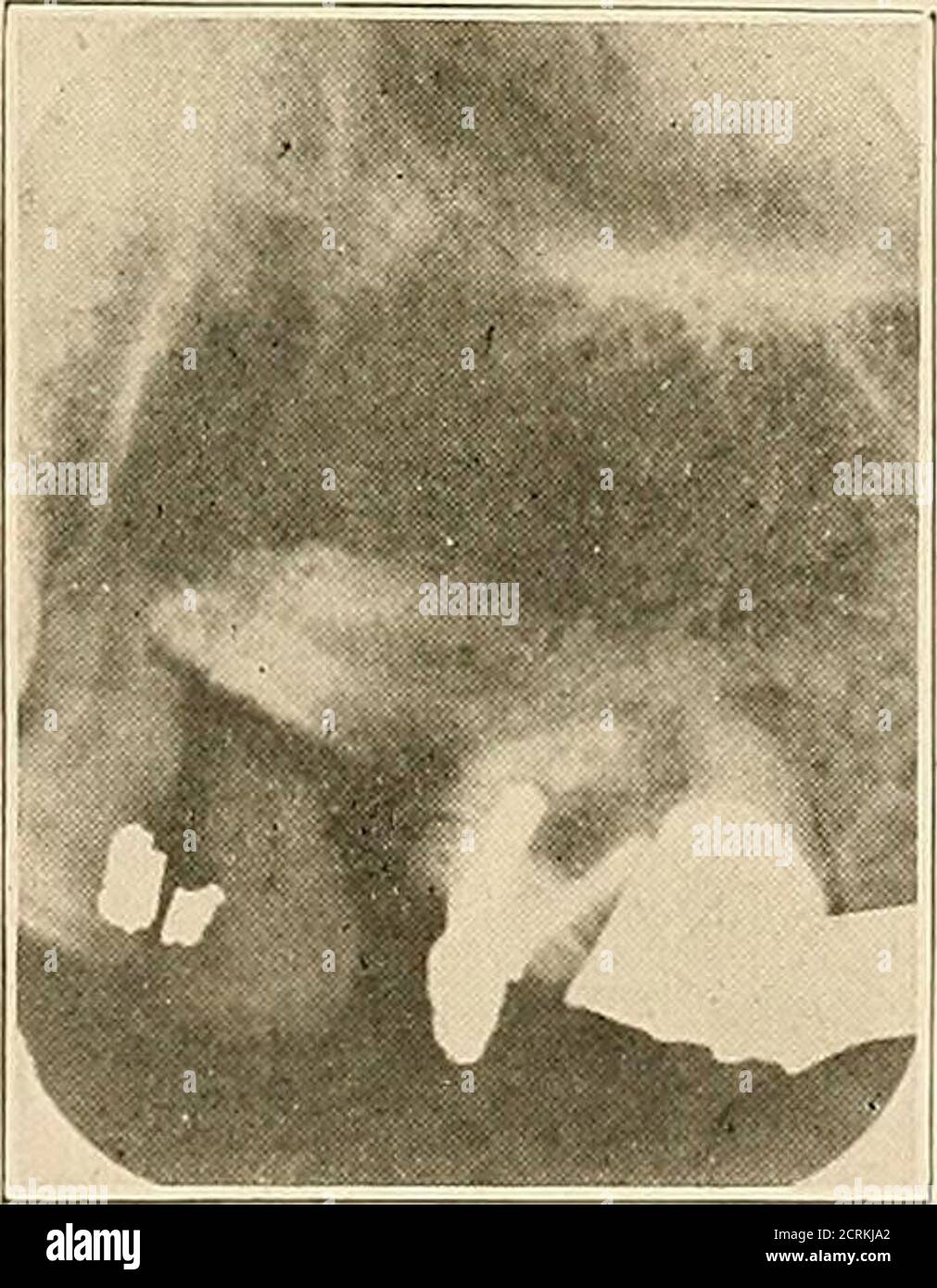 . Interpretation von dentalen & kieferförmigen Roentgenogrammen . Abb. 222. Abb. 223. Stockfoto