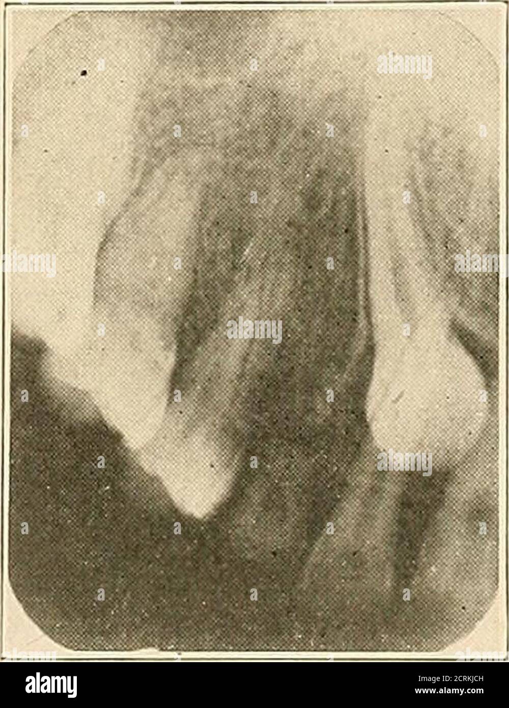 . Interpretation von dentalen & kieferförmigen Roentgenogrammen . Abb. 222. Abb. 223. Stockfoto