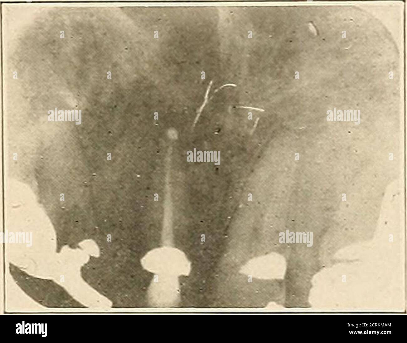 . Interpretation von dentalen & kieferförmigen Roentgenogrammen . Abb. 214. Abb. 215. Stockfoto