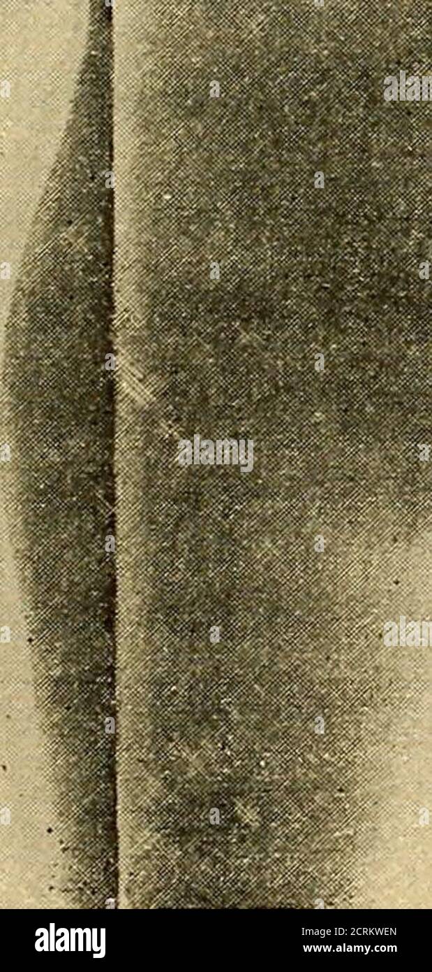 . Traité de radiographie médicale et scientifique : cours libre professé a l'écolepratique de la Faculté de Médecine de Paris, deuxième semestre de 1896-1897 . Abb. 135. - Homme entier radiographié. 268 RADIOGRAPHIE M. Imbert et Bertin-Sans ont obtenu assez nettementle squelette entier dun nouveau-né, en employant un tubefocus placé à 72 centimètres de deux plaques photographiques 24 X 30 nebeneinandergestellt, sur lesquelles le Petit cadavreétait étendu. La pose a été de vingt-cinq minutes pour unebobin de 35 centimètres détincelle. Le Dr Zehnder, Professor à lUniversité de Fribourg, aradiographié Stockfoto