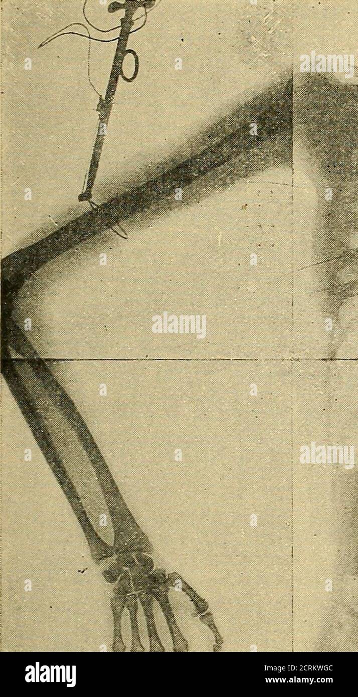. Traité de radiographie médicale et scientifique : cours libre professé a l'écolepratique de la Faculté de Médecine de Paris, deuxième semestre de 1896-1897 . açon, avec la même facilité. Aussi convient-il, selonlobjet à radiographier, de varier le temps de Pose, voiremême sa Position par Rapport aux rayons X, plaçant le côtéà étudier le plus près possible de ces rayons. Le temps de Pose est à déterminer par lexpérience de cha-cun dont nous allons cependant indiquer quelques durées,approximativement et seulement pour lheure présente,cette durée pouvant être diminuée demain par des progrèsimpo Stockfoto