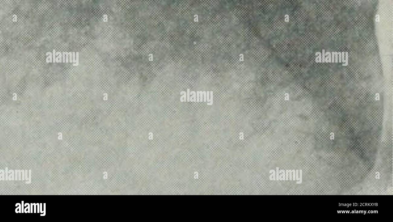 . Die Roentgen Strahlen in der Medizin und Chirurgie als Hilfsmittel in der Diagnose und als therapeutisches Mittel; für den Einsatz von Praktikern und Studenten konzipiert. FK;. Ioo. Die andere Lunge ist ein Patient, der an einer Lungenentzündung starb. Der hellste Teil ist gesund; die dunkelsten Teile sind stärker betroffen als die, die weniger dunkel sind. Diese Lunge wurde auf der gleichen Platte mit der in der vorhergehenden Abbildung gezeigt genommen. Teile der Lunge sind entfernter. Wenn die Dichte viel über der Oberfläche liegt, wie bei der zentralen Lungenentzündung, wird ihre Anwesenheit nicht durch körperliche Untersuchung erkannt; ein Schatten jedoch des konsolidierten Teils Stockfoto