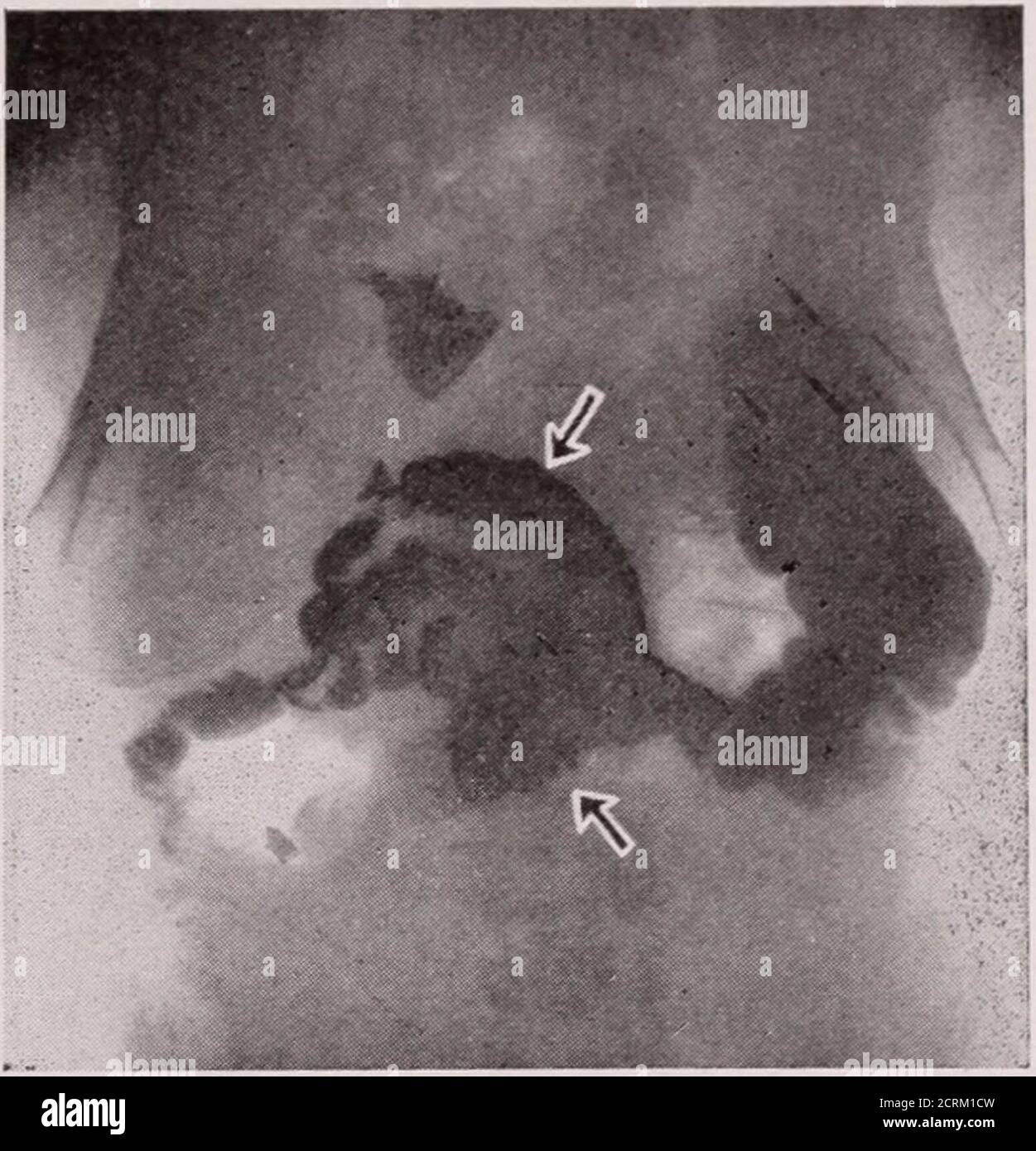 Journal of Radiology . ual childrensdiseases. Hat sonst nie beenill mit  Ausnahme, dass er mit Hämorrhoiden für die letzten zwanzig-rive Jahre  beunruhigend gewesen. .-gegenwärtige Krankheit: Threeweeks vor intensiven  Schmerzen in seinen