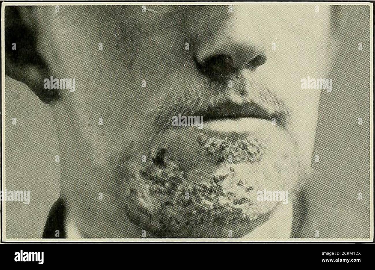 . Strahlentherapie und Phototherapie : einschließlich Radium und Hochfrequenzströme, ihre medizinischen und chirurgischen Anwendungen in der Diagnose und Behandlung ; für Studenten und Praktiker . HE Radiochromometer Skala. Nach 53 tagen war das Haar wieder gewachsen. Freund findet, dass mit einem harten Rohr vier bis sechs, acht- Tote-Minuten-Sitzungen auf 15 cm. Genügen. In 17 Fällen waren 5 in einem Kurs vollständig geheilt; 5andere hatten ein Rezidiv, 3 Fälle zwei, und ich Fall drei.zu Zeiten nach leichten Expositionen erschienen die Läsionen aggra-vated, erforderten Beendigung des Strahlens und beruhigende Anwendungen bis zur Entzündung Stockfoto . Strahlentherapie und Phototherapie : einschließlich Radium und Hochfrequenzströme, ihre medizinischen und chirurgischen Anwendungen in der Diagnose und Behandlung ; für Studenten und Praktiker . HE Radiochromometer Skala. Nach 53 tagen war das Haar wieder gewachsen. Freund findet, dass mit einem harten Rohr vier bis sechs, acht- Tote-Minuten-Sitzungen auf 15 cm. Genügen. In 17 Fällen waren 5 in einem Kurs vollständig geheilt; 5andere hatten ein Rezidiv, 3 Fälle zwei, und ich Fall drei.zu Zeiten nach leichten Expositionen erschienen die Läsionen aggra-vated, erforderten Beendigung des Strahlens und beruhigende Anwendungen bis zur Entzündung Stockfoto
