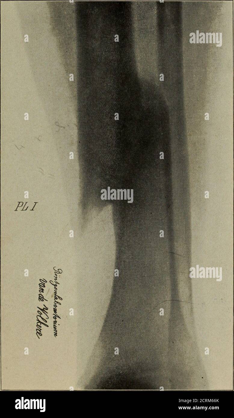 . Röntgentechniek : therapeutische beteekenis der 'X' -stralen en der stoomen van hooge fréquentie . uim.Uit de radiografie blijkt, dat het beentje reeds gedeeltelijkaangegroeid is. (Men bedenke, dat de patiënt zich pas 6weken na het breken bij den Arts vervoegde, in de meening,dat de Hand verstuikt was.) Het beentje is toen opnieuwgebroken, goed gezet en Zoo vertoont, PLAAT IV.De genezen Hand. PLAAT V. Hand, waaraan twee pinken geweest zijn. Eén rosa isafgezet; een klein overblijfsel is nog zichtbaar. Eigenaardigis het volgende: De plaat is de radiografie van een man, dieaan één Hand twee PIN Stockfoto