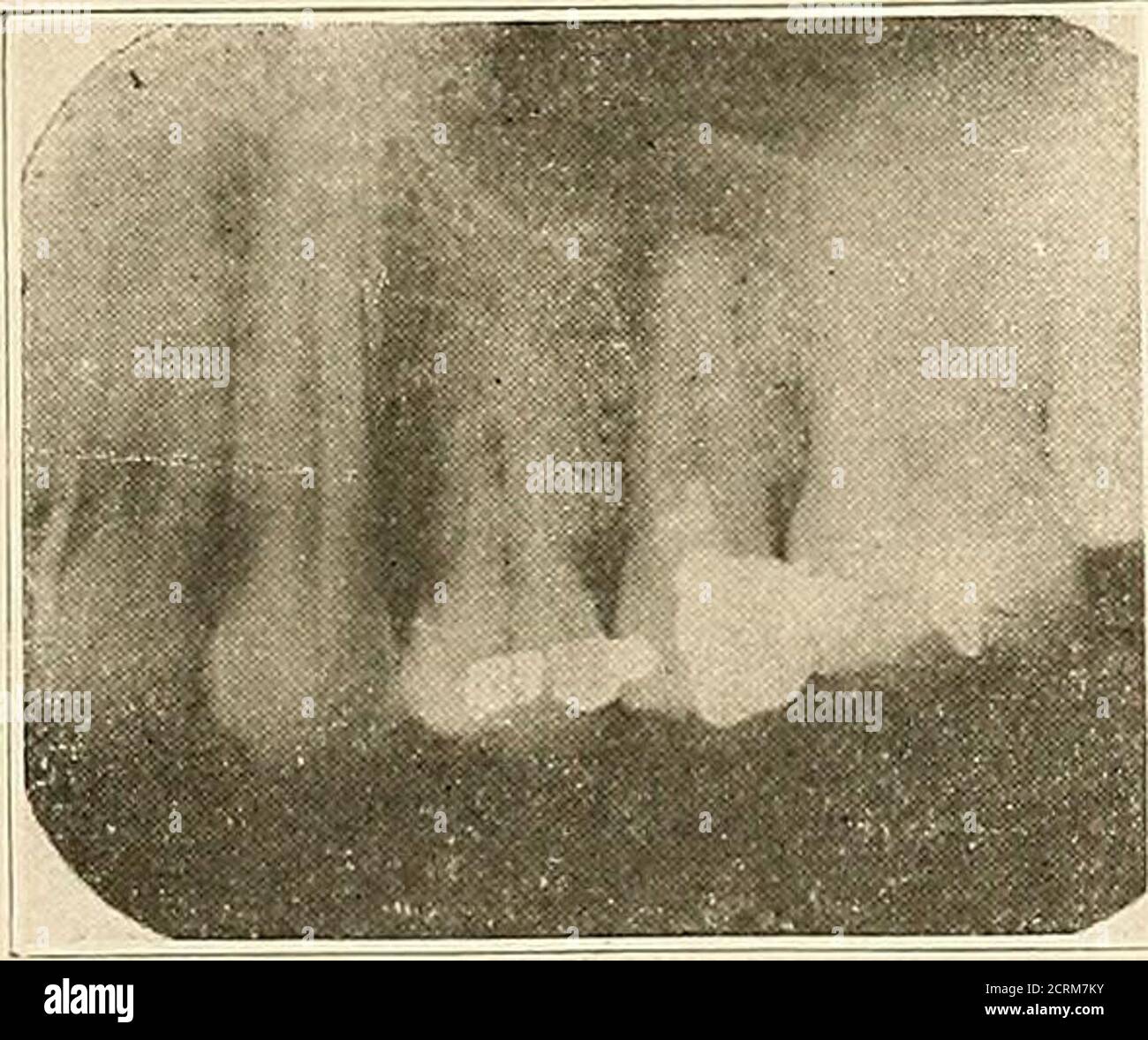 Periapikales granulom Fotos und Bildmaterial in hoher Auflösung Alamy