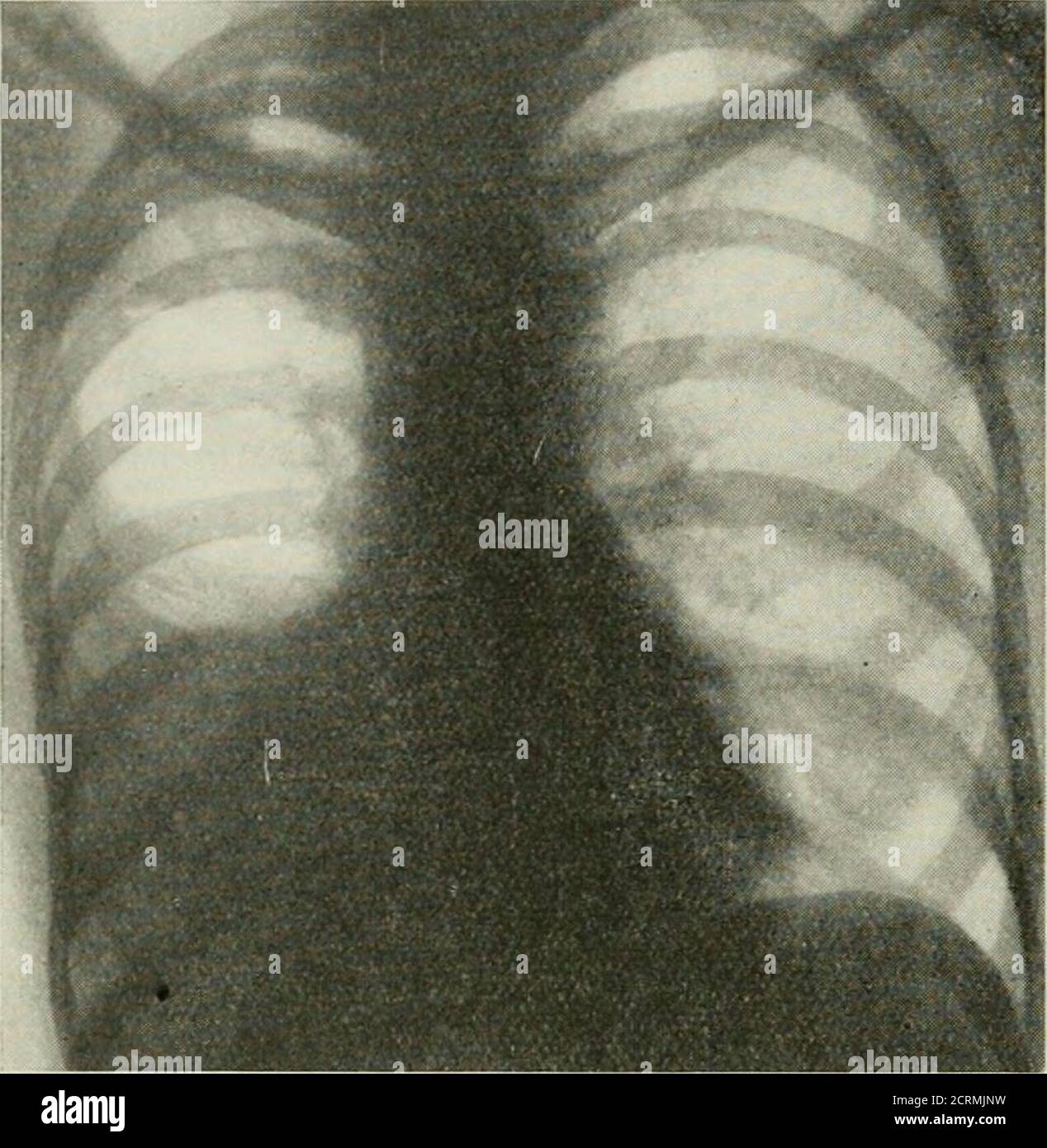 Parietale pleura Fotos und Bildmaterial in hoher Auflösung Alamy