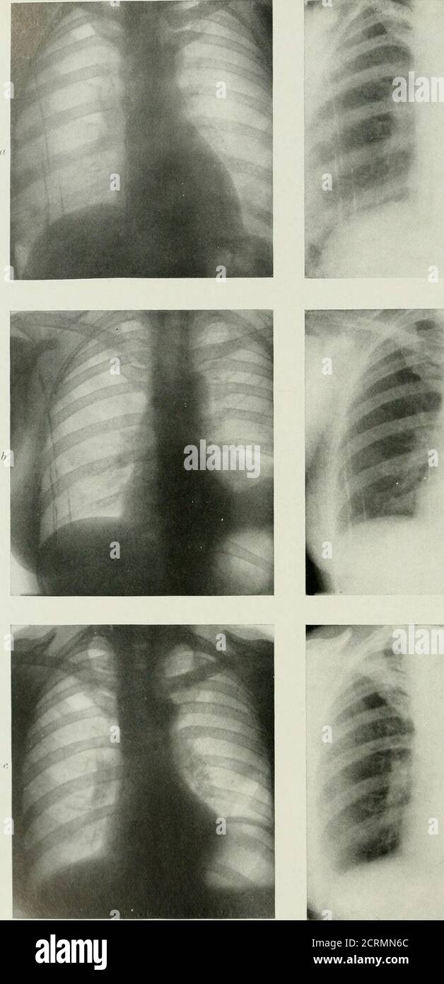 . Radiographie und Radiotherapie . PLATTE L. – bösartige Erkrankungen der Brust. , sekundäre Ablagerungen von Sarkom in Mediastinum und Lunge. /), Lympho-Sarkom von niediastinuni, erstreckt sich nach außen von der Wurzel der Lunge in Richtung der Peripherie.c, sekundäre Ablagerungen von Krebs mit mediastinalen Drüsen, Lungensubstanz, und Pleura ; die Zwerchfellflächen der rechten Lunge und der Leber sind ebenfalls beteiligt.. •sSbSS;-- Stockfoto