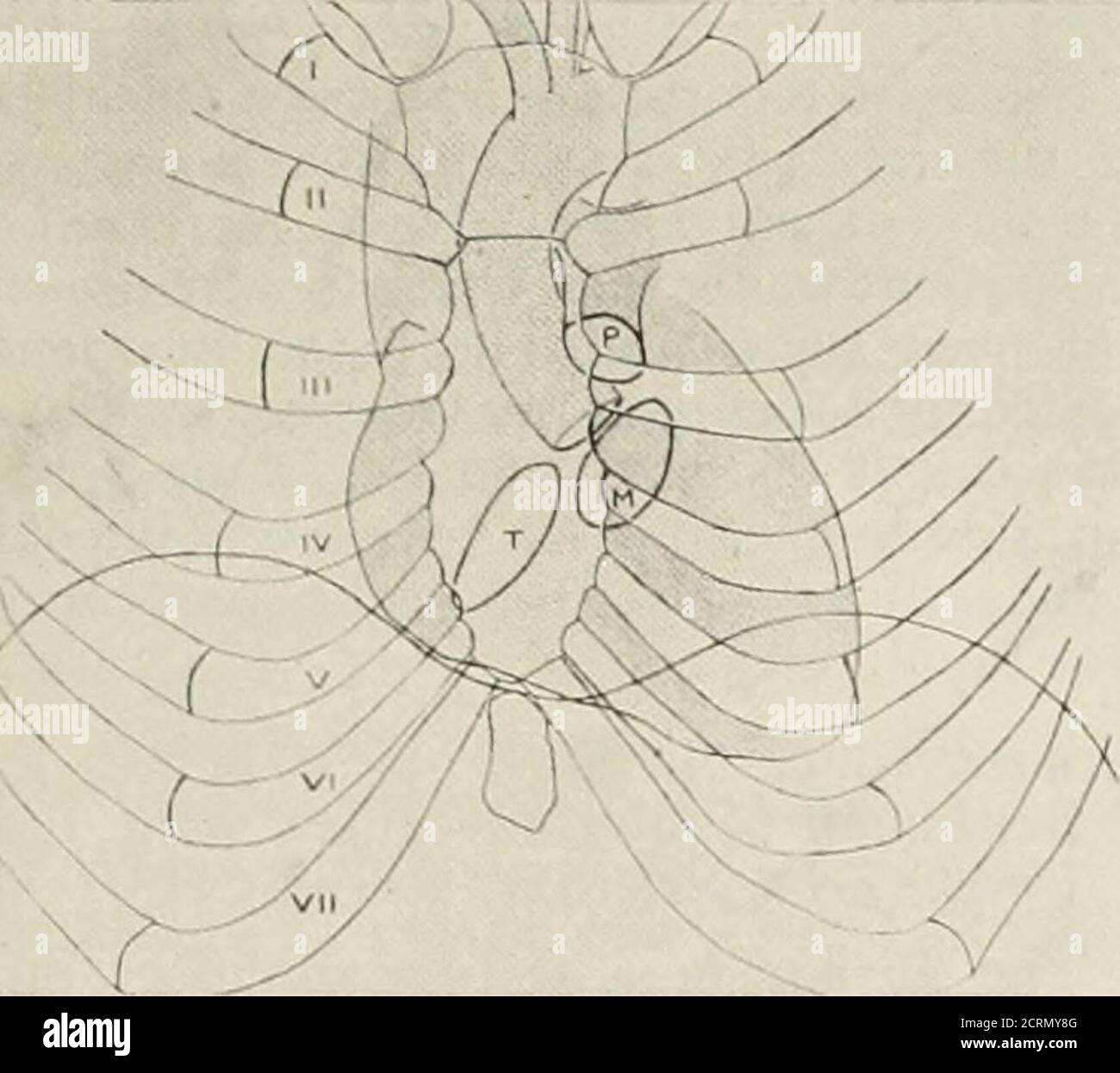 . Die amerikanische Zeitschrift für Roentgoenology, Radium Therapy and Nuclear Medicine . s, der Vergleich von pairedexposures in der ventrodorsalen und der dorso-ventralen Positionen ist von Wert. In Ermangelung der vertikalen Mobilität, nicht sogar die zusätzliche Hilfe der Pyelographie wird immer von einem Paar kongenitallystopische Nieren unterscheiden, die an ihren sur-Rundungen haften. Eine Gleichheit der Ptose macht die Hufeisenniere jedoch wahrscheinlicher. Der Autor bezieht sich auf Berichte von einem Fall vonQuarteros und einem von van Hasselt, in welchem seine Methode die Diagnose stellte, und von de Groot von der Vereinbarung zu sein Stockfoto