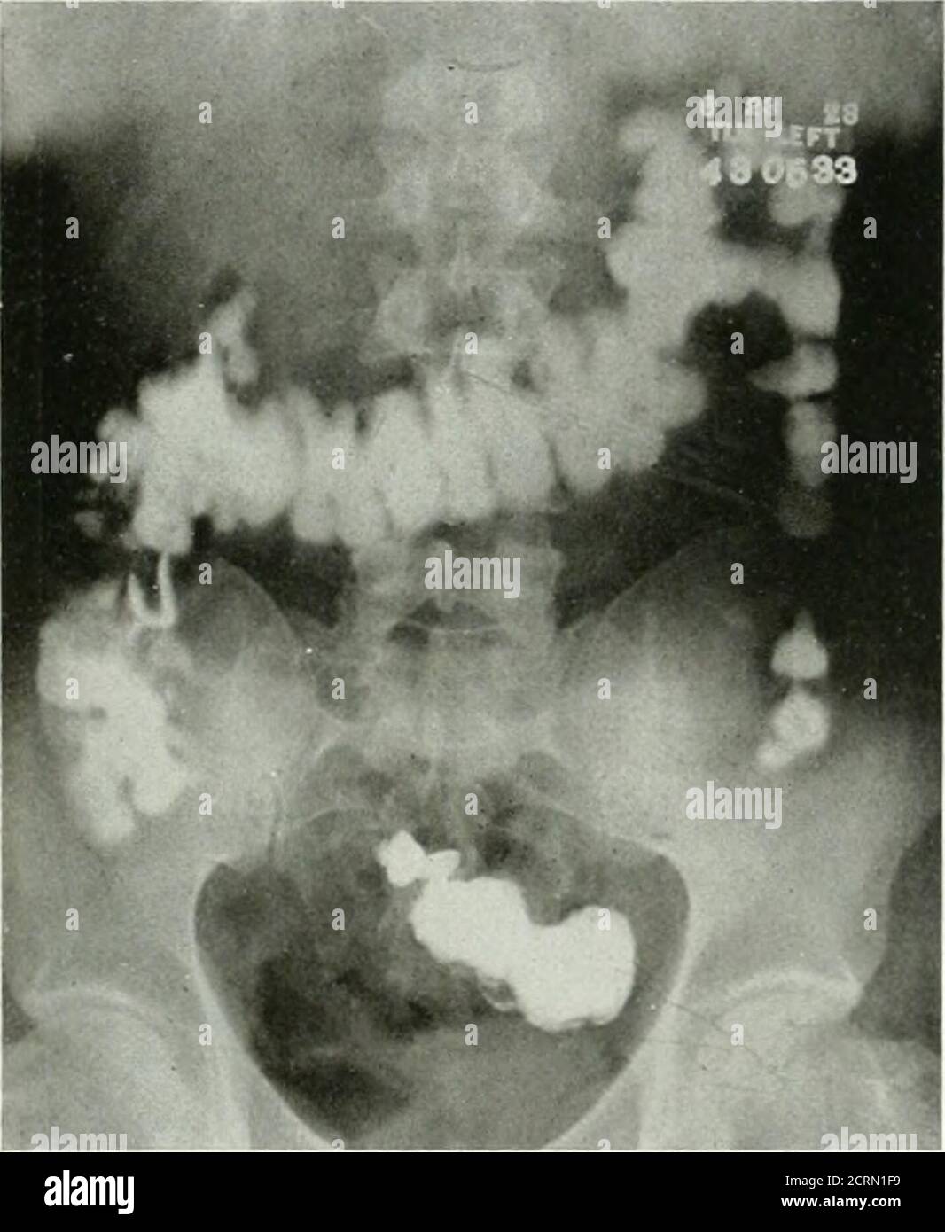 . Die amerikanische Zeitschrift für Roentgoenology, Radium-Therapie und Nuklearmedizin . Abb. 3. ((^a^e A430533). Roentgenogramm zeigt einen Fremdkörper, Zaunstapel, offenbar im Hauptbronchus (mit freundlicher Genehmigung von Dr. W. A. Rush). Am 2. Mai 1923 wurde eine Bronchoskopie unter Lokalanästhesie durchgeführt, Abb. 6. (Rechtssache A430533). Roentgenogramm zeigt keine Anzeichen des Fremdkörpers im Bronchus. ING Bronchus. Die Pinzetten wurden durch die Striktur in die kleine Hohlhöhle eingeführt 9IO Fehler in der Diagnose von Fremdkörpern in den Luftdurchgängen unten, aber der vermeintliche Fremdkörper konnte n Stockfoto