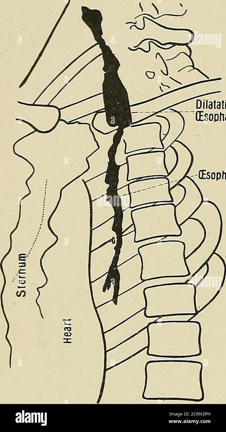 . Radiographie und Radiotherapie . Ösophagus.die Krankheiten, die am ehesten Schwierigkeiten verursachen, sind: (1) einfache Verengung mit Erweiterung der Ösophagus oben ; (2) bösartige Erkrankung mit oder ohne Erweiterung ; (3) einfache Dilatation, Kardiospasmus. (Ösophagusobstruktion. - die Ursachen der Ösophagusobstruktion arenumerous, und kann in mehrere Gruppen unterteilt werden : (1) Obstruktion durch Druck von außen. - Dies ist in der Regel aufgrund von Erkrankungen anderer Organe, wie Aneurismus ; neues Wachstum des Mediastinum, Lunge, Pleura ; Tumor der Wirbelsäule ; vergrößerte mediastinale Drüsen ; mediastinalabszess. 1 T Stockfoto