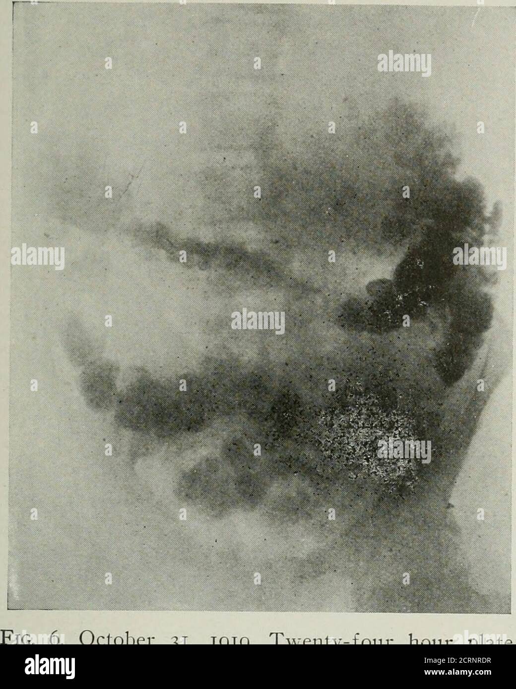 . Die amerikanische Zeitschrift für Roentgoenology, Radium-Therapie und Nuklearmedizin . Abb. 5. 30. Oktober 1919. Anterior-posterior Ansicht, zeigt Gastro-Enterostomie. Praktisch doppelt so groß. Bei gleicher zeitmenge wurde die Bariummischung durch die Gastricarea ausgebreitet und unter Annahme der Magenform und gastrokolischen Fistel 519 das Auftreten von Rugae serviert. Eine Platte wurde sofort gemacht, die diese Beobachtung bestätigte.die Öffnung vom Dickdarm zum Magen. 6. 31. Oktober 1919. 24-Stunden-Teller. Drei Tage später, nach einer gründlichen Ca-tharsis und vorbereitenden Reinigung, dieb Stockfoto