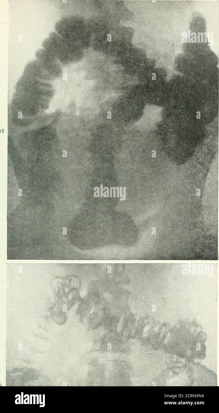 . Radiographie, Röntgentherapeutika und Radiumtherapie . wird durch die Verabreichung von kleinen Pflaumengewächsen aus befeuchter Watte durchgeführt. Die erste übliche Stelle, an der ein Fremdkörper, der den Darm blockiert, zu finden ist, ist dieo-ca3cal-Klappe. Wenn sich ein Fremdkörper im Aximentarytrakt befindet, sollte der Patient regelmäßig gescreent und radiographiert werden.der Körper wird somit unter strenger Beobachtung gehalten und sollte eine Operation notwendig werden, kann er mit möglichst wenig Verzögerung durchgeführt werden. Stereoskopische Röntgenaufnahmen, die unmittelbar vor einer Operation aufgenommen wurden, oder die zum Zeitpunkt der Operation OFX-Strahlen verwenden, Stockfoto