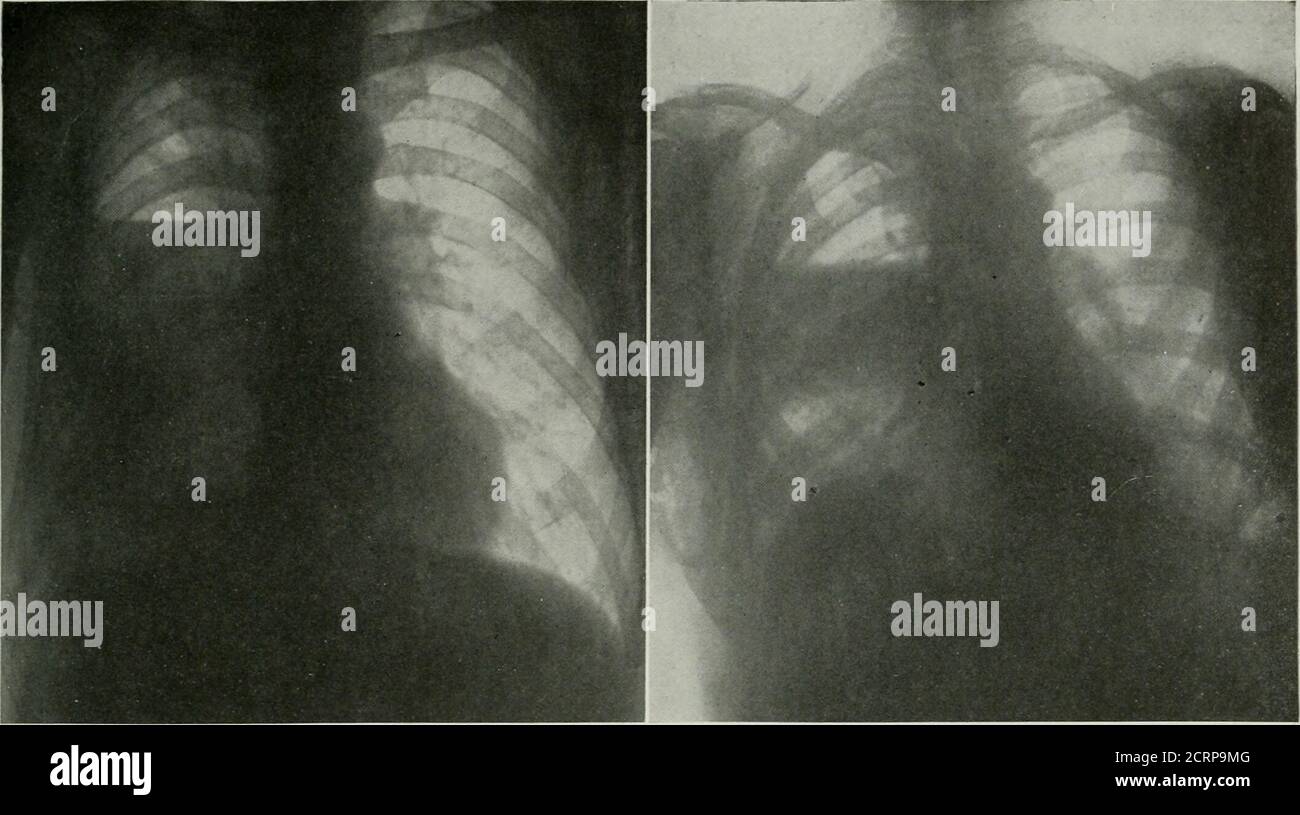 . Die amerikanische Zeitschrift für Roentgoenologie, Radiumtherapie und Nuklearmedizin . g ob die Platten in tiefer Inspiration oder in Exspiration erhalten wurden. Die Reflexionslinien der Pleura inferiorly sind anteriorly auf der Ebene der achten Costochondral Kreuzung, mam-mar^• Linie, die zehnte Rippe in der midaxillaryline, und von dort zum Dornfortsatz des zwölften thorakischen Wirbels. Die Variationzwischen den beiden Seiten ist unwichtig, daher kann jede Pathologie, die im posteriorphrenocostalischen Raum auftritt, nicht auf den Standard-anteroposterioren Platten dargestellt werden. Es ist wahr, dass Teller in tiefen ins gemacht Stockfoto