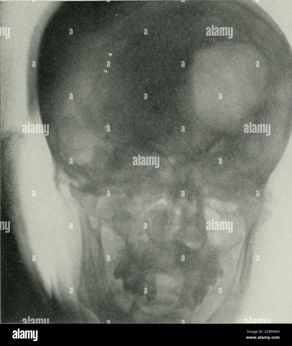 . Die amerikanische Zeitschrift für Roentgoenology, Radium-Therapie und Nuklearmedizin . o Blutungen und keine Hinweise auf previoshemorrhage. Die Dura wurde so weit wie möglich aus dem Schädel befreit, um es zu ermöglichen, einen Kollaps zu machen und die Reformierung der Lufthöhle zu verhindern. Der Zustand des Patienten verschlechterte sich rapidlywurde und er starb am nächsten Tag. Die Autopsie zeigte zwei Durchgangsdurchgang der Dura und eine deprimierte Fraktreüber der äußeren Hälfte der Umlaufbahn, die sich in einer Richtung zum zeitlichen Bereich und in der anderen Richtung zur cribriformen Platte des Ethmoids ausdehnend. Das Hirngewebe in theaftected Bereich war weich und tat Stockfoto