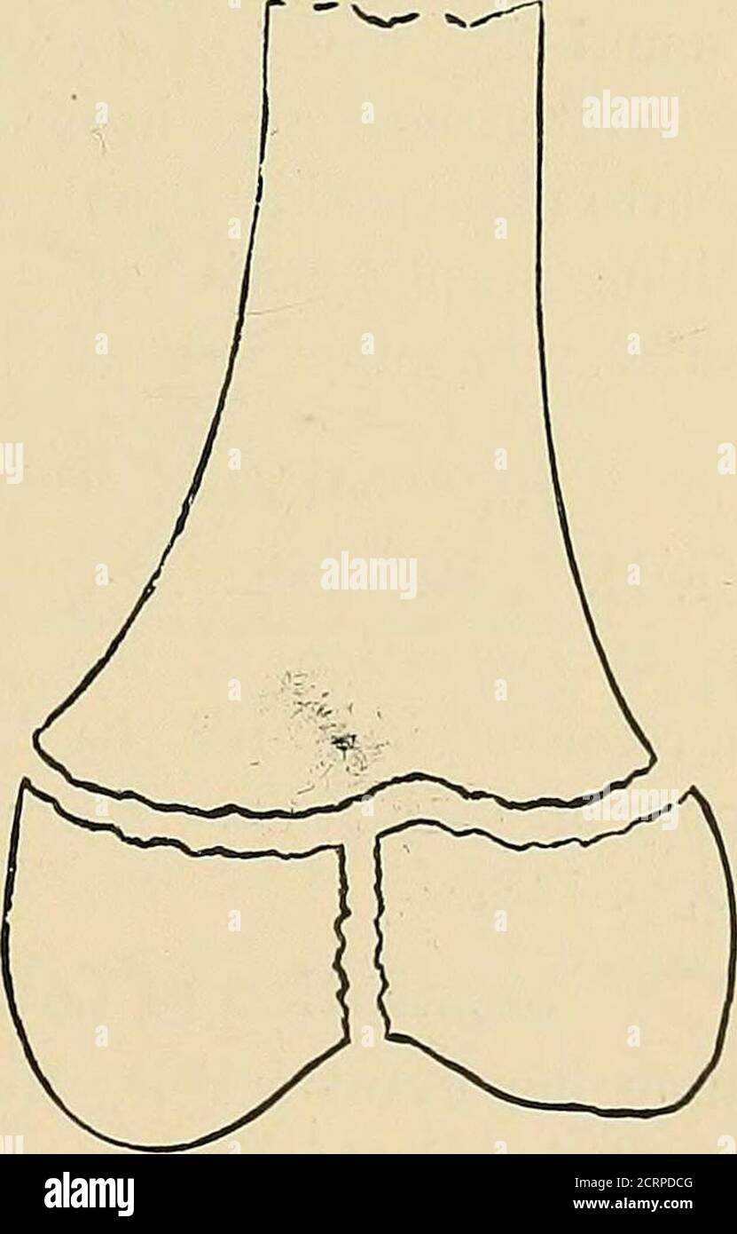 . Die Röntgenstrahlen in der medizinischen Arbeit . Abb. 116. – partielle Trennung,mit Fraktur der Epiphyse. Abb. 117. – vollständige Trennung, mit Bruch der Epiphyse. Aus Polands traumatische Trennung der Epiphysen, 1898. 16 242 DIE RONTGEN RA YS IN DER MEDIZINISCHEN ARBEIT die Bedeutung einer genauen Diagnose in dieser Klasse der Injuriese ist klar, da daraus oft schwere Fehlbildungen resultieren. Eine bestimmte Anzahl von so genannten angeborenen Missbildungen wird zweifellos während der Geburt auf diese Weise verursacht. Bisher hat der Chirurg jedoch durch den Mangel an exakten Diagnosemethoden und durch den Mangel an exakten pathologischen d gebremst Stockfoto
