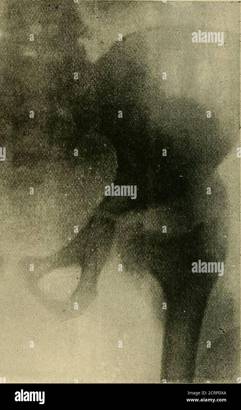 . Die Röntgenstrahlen in der medizinischen Arbeit . Abb. 112. - angeborene Dislokation der rechten Hüfte, nach der Operation.Herr Fall Robert Joness. Dr. Morgan. Es gibt einen Bruch durch den Hals des Astragalus, während der Körper mit der trochlearen Oberfläche in Kontakt mit dem tendo Achillis nach hinten abgesetzt wird; mit anderen Worten, es gibt eine axiale Rotation von 90 Grad rückwärts durch die itstranssverse Achse, gegen den Uhrzeigersinn. Es gibt keine Knochenbildung in der Lücke zwischen dem Hals und dem verdrängten Körper des Astragalus, denn der fibuläre Malleolus ist deutlich erkennbar. Thetibial malleolus wird gesehen, die auf dem ruht Stockfoto