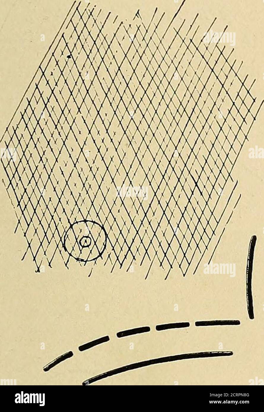 . Die Roentgen Strahlen in der Medizin und Chirurgie als Hilfsmittel in der Diagnose und als therapeutisches Mittel : konzipiert für den Einsatz von Praktikern und Studenten . d mit Auskultation und Schlagzeug. John H., 60 Jahre alt, trat am 30. Dezember 1899 in meinen Dienst im Boston City Hospital ein. Diagnose: Alte Tuberkulose. Eine sorgfältige Untersuchung auf Tuberkelbazillen war negativ. Die physischen Zeichen waren wie folgt: Herz: Rechter Rand 3 centi-Meter rechts von Medianlinie; linker Rand 14.5 Zentimeter links von Medianlinie; oberer Rand an zweiter Rippe; Scheitelpunkt im fünften Raum, 2.5 centi-Meter außen; kein Murmeln Stockfoto