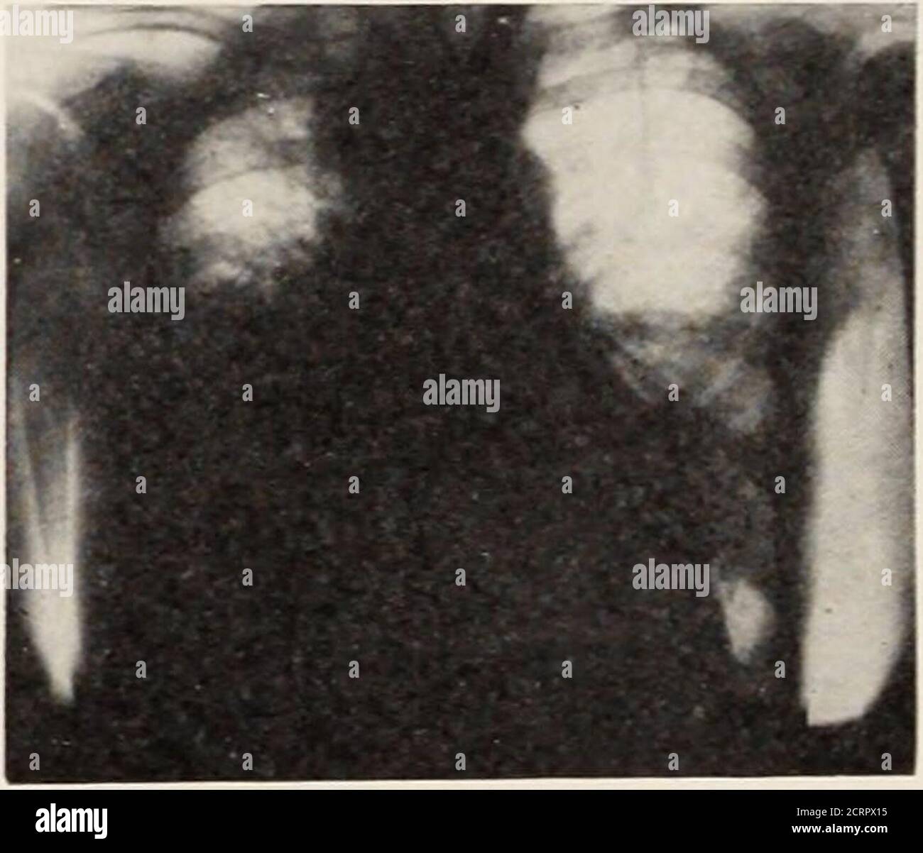 Interlobuläre fissur Fotos und Bildmaterial in hoher Auflösung Alamy