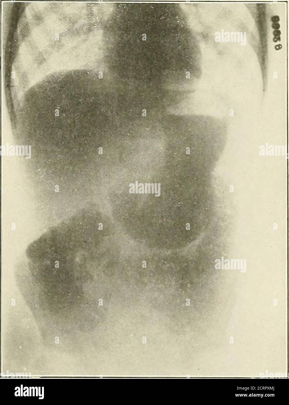 . Die Grundsätze und Praxis der roentgenologischen Technik . Abb. 275. Abb. J70 190 GASTRO-INTESTINALE TRAKTENTECHNIK ZUR RADIOGRAPHISCHEN UNTERSUCHUNG DES THEGASTRO-INTESTINALEN TRAKTES 1. Mahlzeit zur Rückstandsuntersuchung und B. Mahlzeit a. Vorbereitung – no eveningenema Carboh vdrate 400 gms.bis. Subcarb. 60 gms. c. Untersuchung – sechs Stunden nach Inges-tion d. Körperhaltung: Vertikal z. Belichtung: Dorso-ventral 2. Sedimentationstest a. iIeal-Bariumsulfat 1 oz. In Wasser4 oz. b. Untersuchung während der Einnahme c. Haltung: Vertikal, rechts lateral, hori-zontal d. Exposition Dorso-ventral nach palpa-tion 3. Morphologie ExAiiiNATioN A Stockfoto