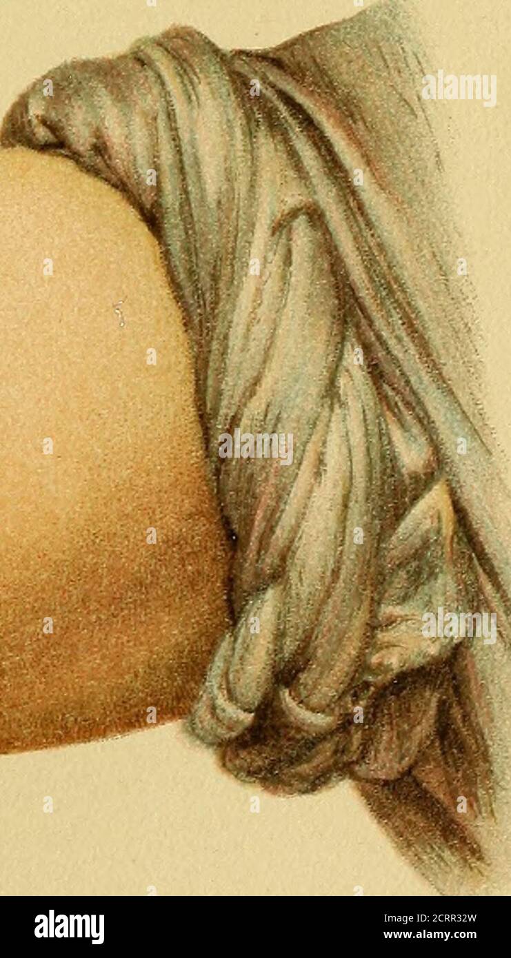 . Atlas und Grundriss der Unfallheilkunde sowie der Nacherkrankungen der Unfallverletzungen : mit 40 farbigen Tafeln, nach originaldeutschen malers Johann Fink und 141 schwarzen Abbildungen . ¥. Lüh. AAST F. Reichhotd-, München. 3i3 in Pronation, Handgelenk geschwollen, sämtliche Finger, sowie Handund Ellbogengelenk steif, passiv nur wenig beweglich. Zwei lange, vollständig Erwachsene Narben auf der Streckseite des Unterarms bis zum Ellbogengelenk. Ganzer Arm unbrauchbar.wird mit 60% am 17. März 1894. Schwere Zermalmungen kommen auch vor, wenn derUnterarm zwischen die Kammr Stockfoto